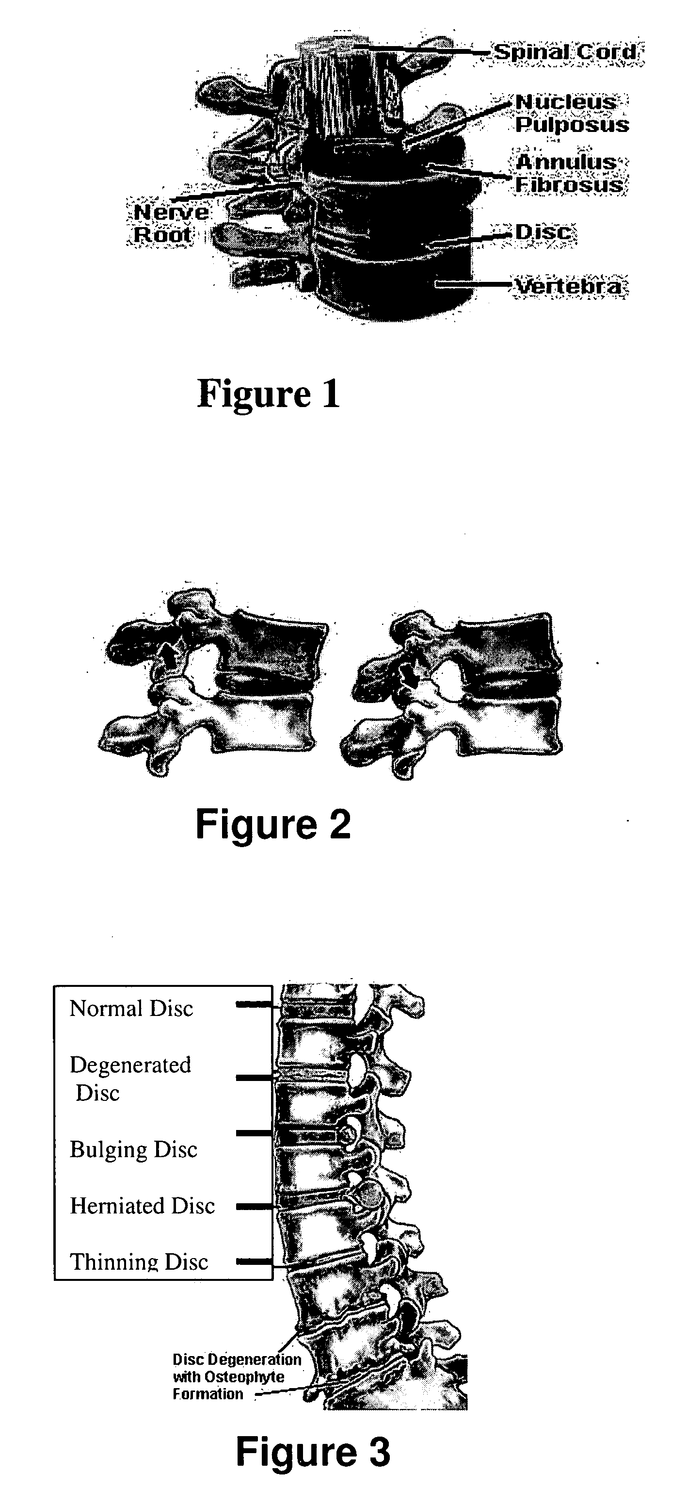 Surgical staples and methods of use thereof