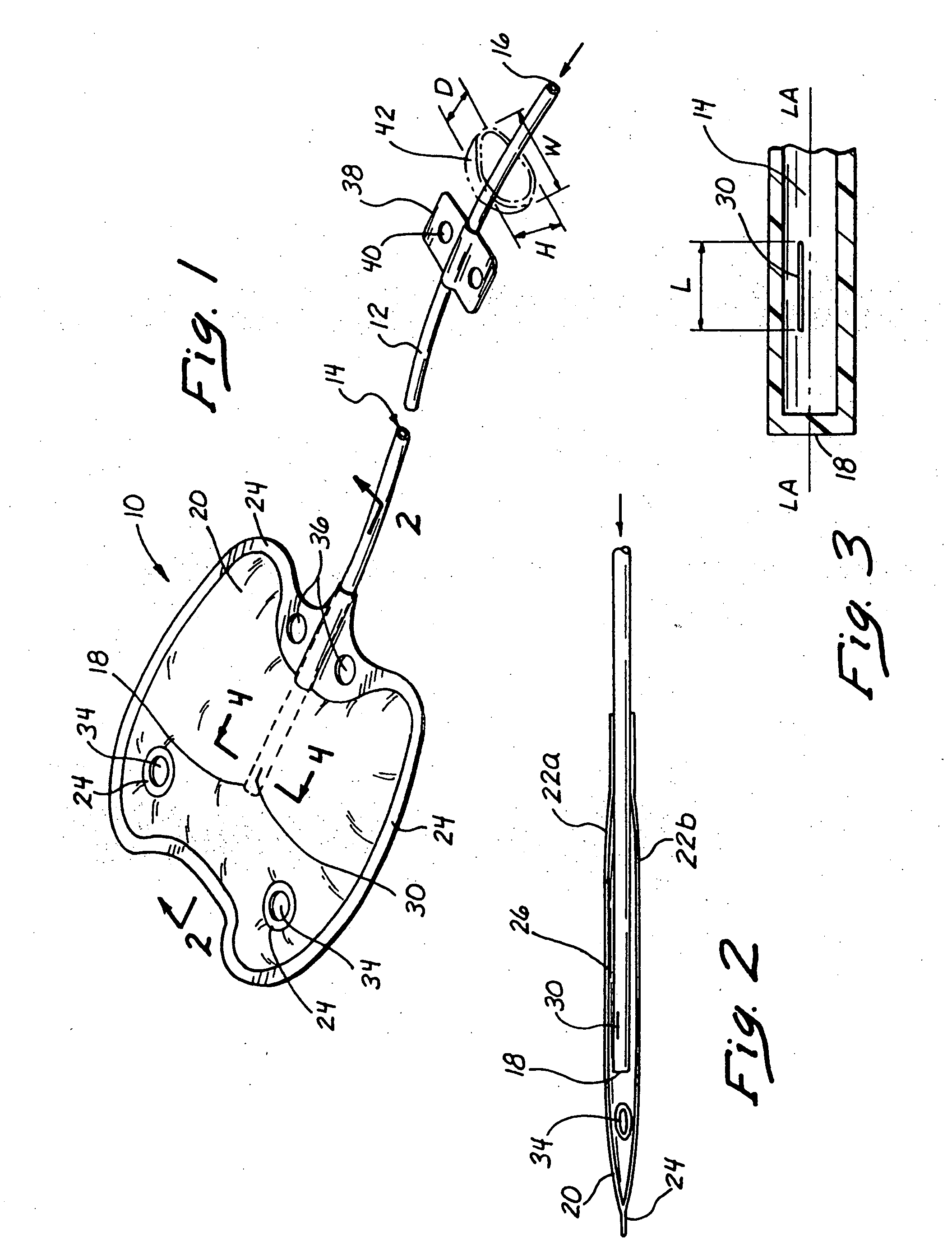 Sutureless implantable device and method for treatment of glaucoma