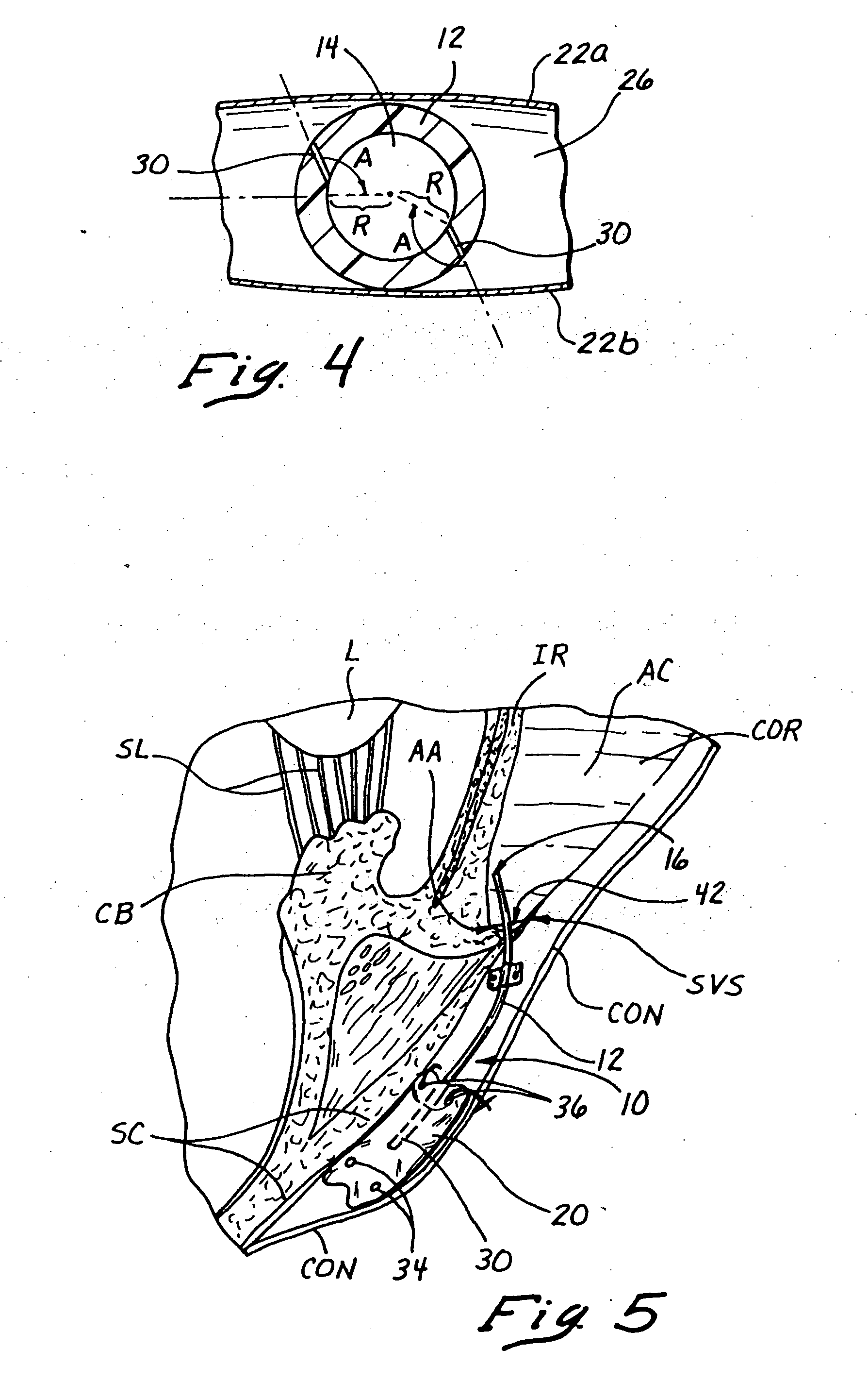 Sutureless implantable device and method for treatment of glaucoma