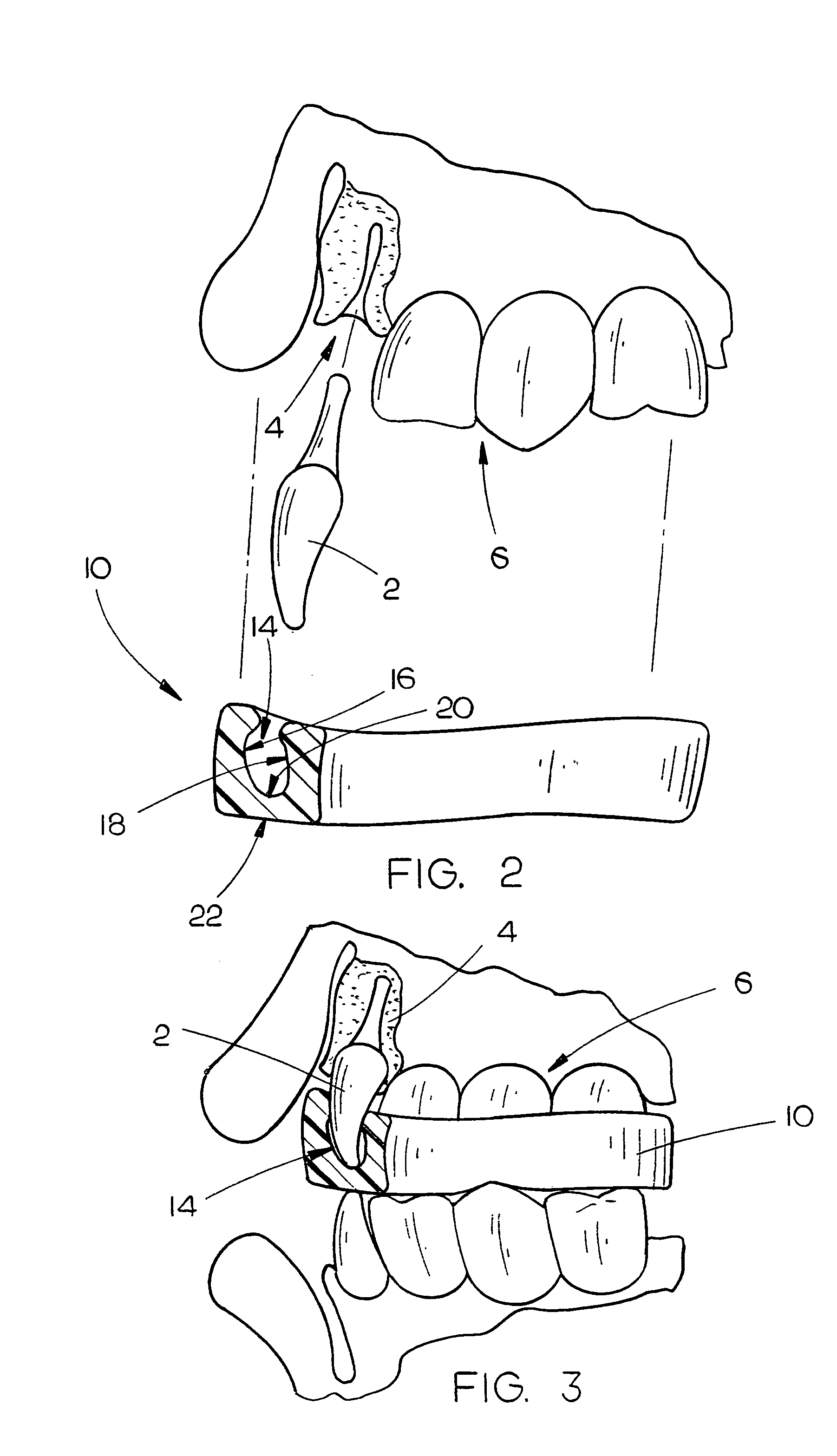 System and method for reimplanting avulsed teeth