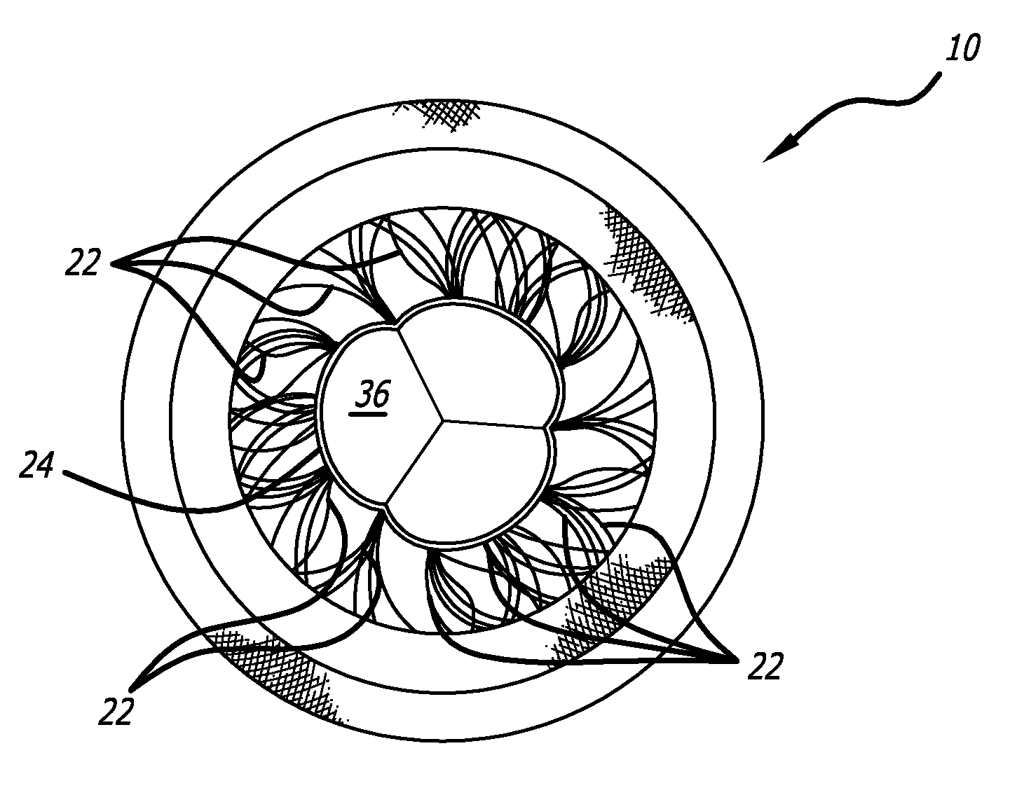 Stentless Support Structure