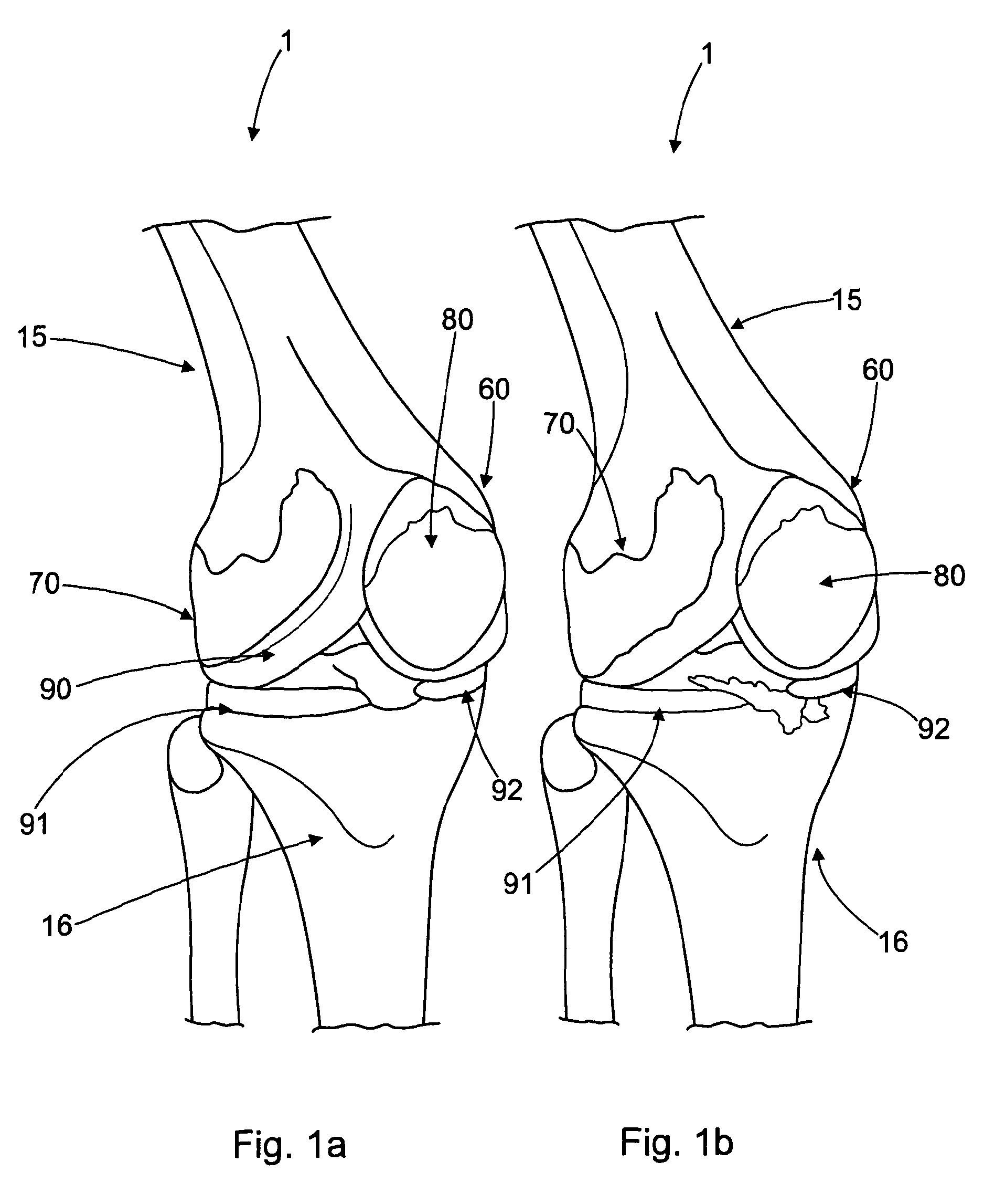 Tibial prosthetic component for a partial or unicondylar bearing knee replacement, method of selecting such a tibial prosthetic component, method of implanting such a tibial prosthetic component and a kit for a surgeon