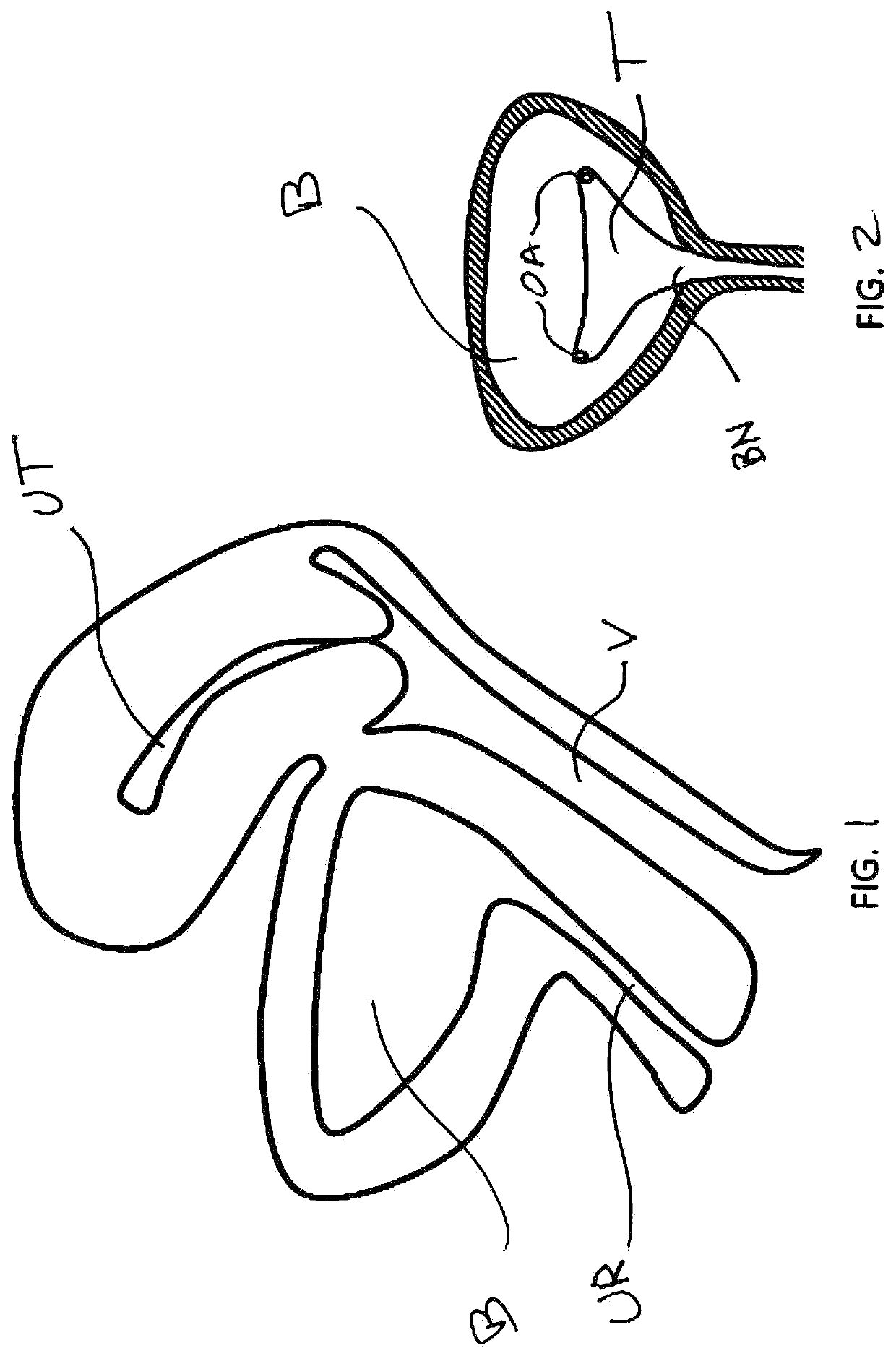 Devices and methods for treating conditions caused by affarent nerve signals