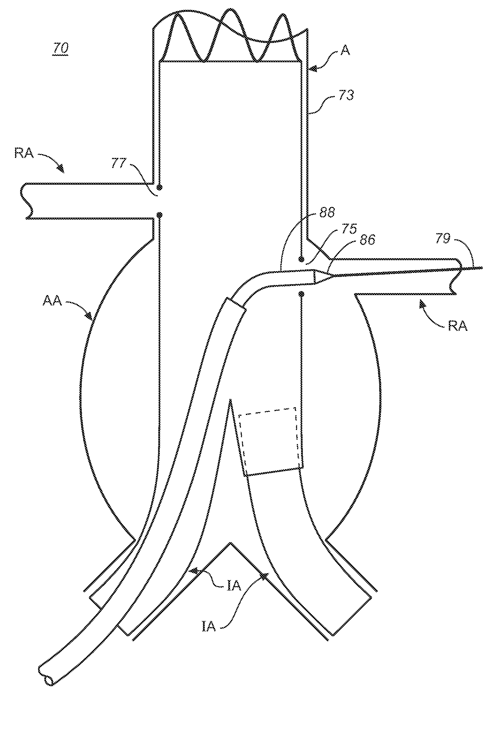 Branch Vessel Graft Method and Delivery System