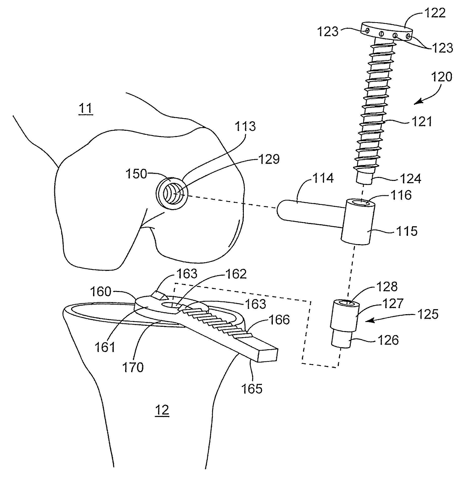 Systems and methods for guiding cuts to a femur and tibia during a knee arthroplasty