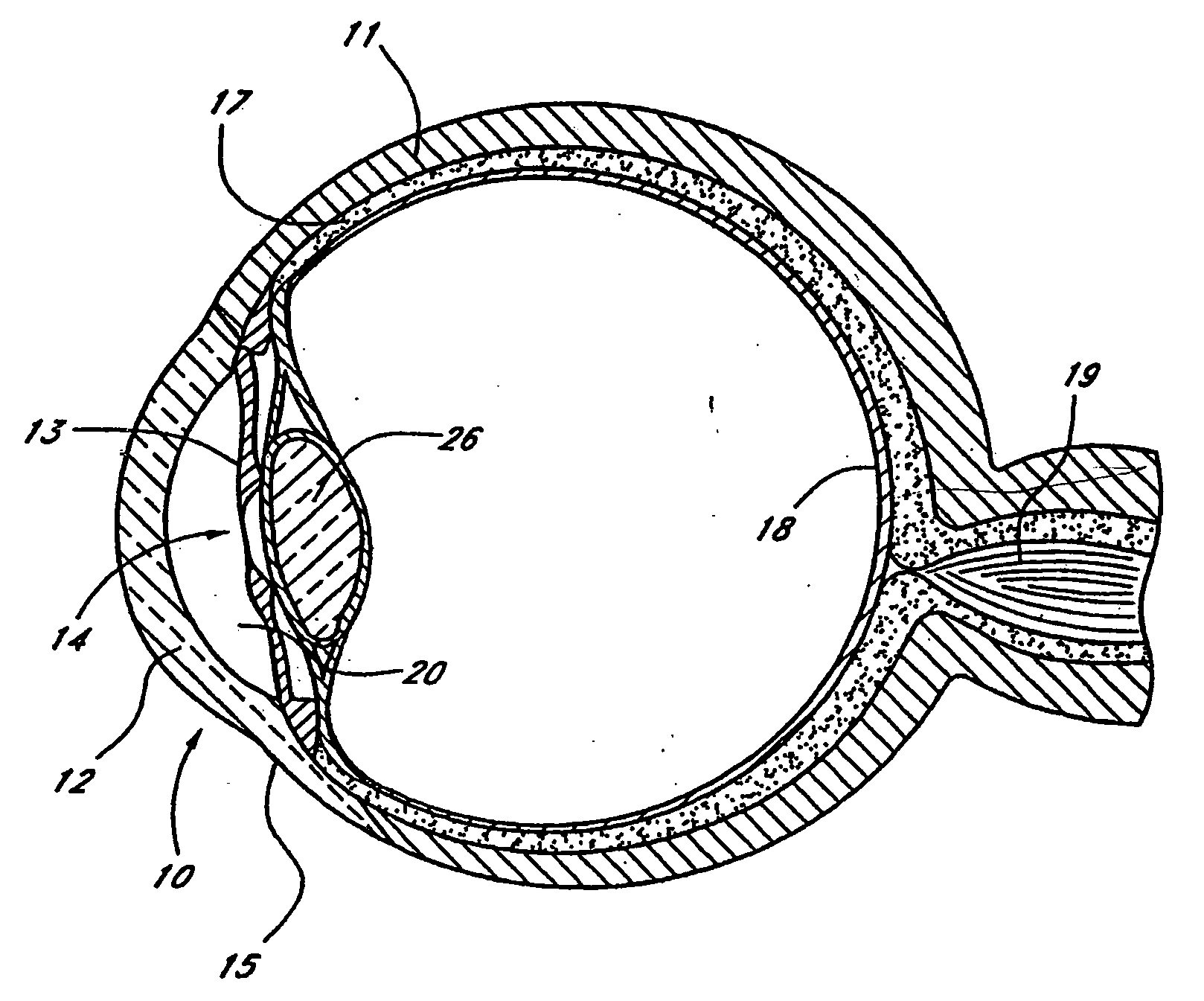 Glaucoma implant with therapeutic agents