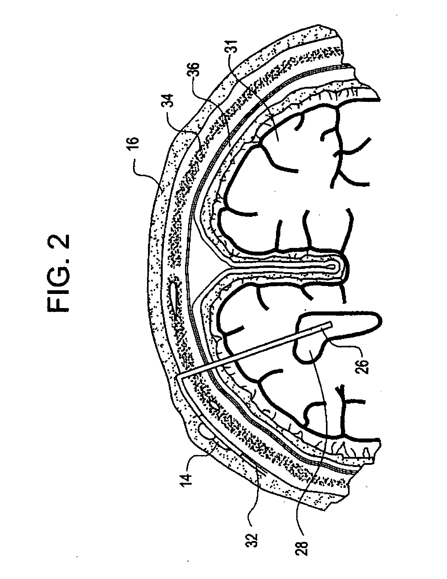 System for transcutaneous monitoring of intracranial pressure