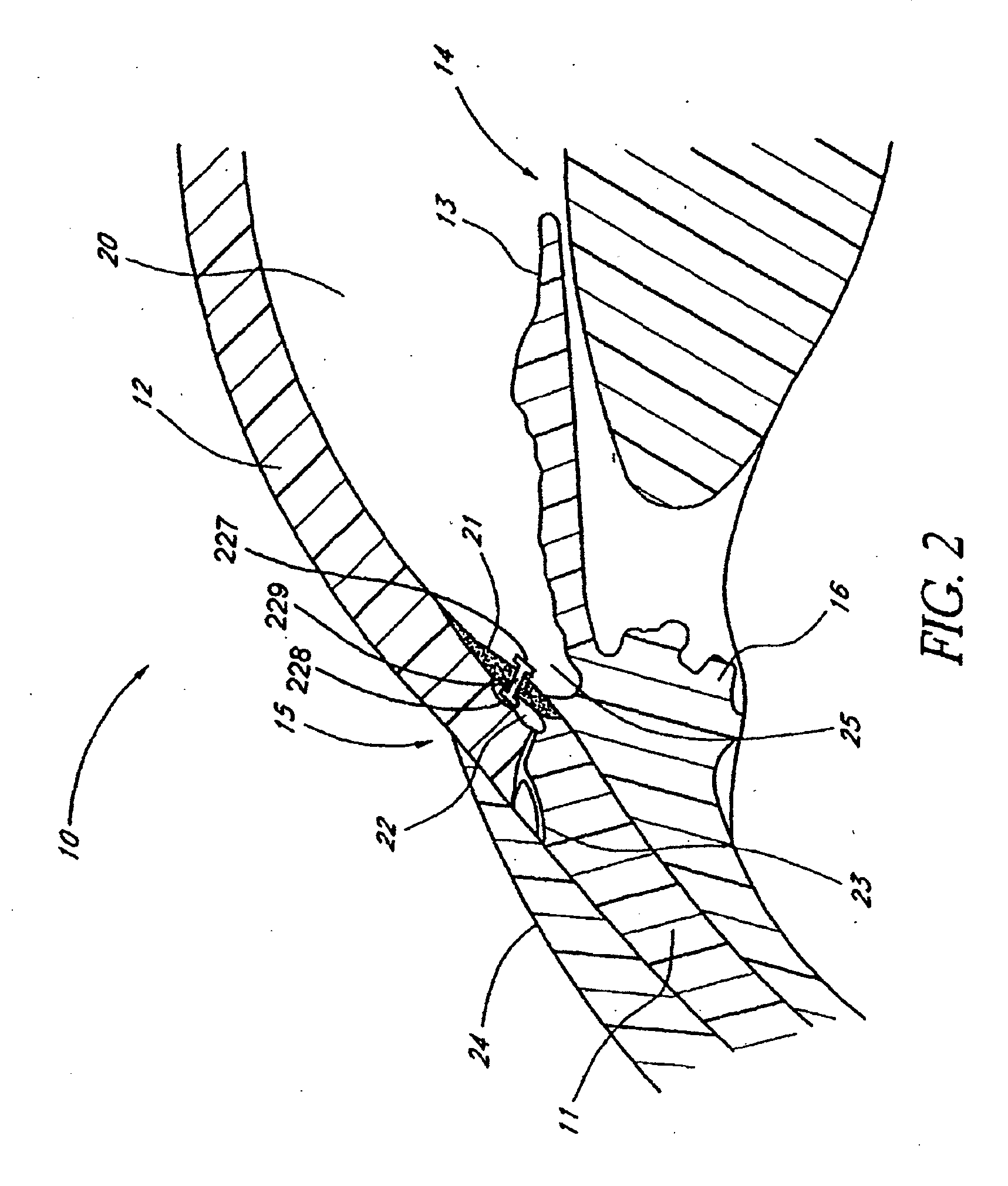 Devices and methods for glaucoma treatment