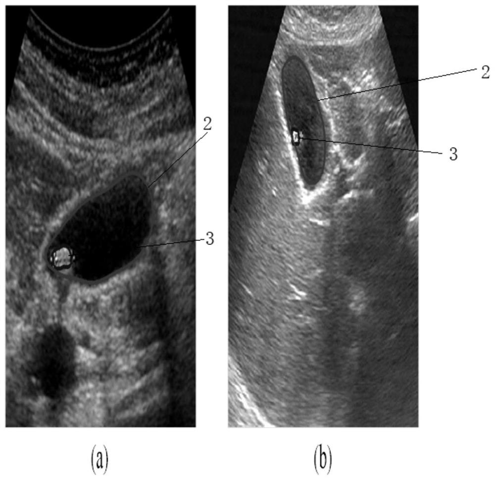 Automatic segmentation method of ultrasound images of gallbladder stones based on mspcnn
