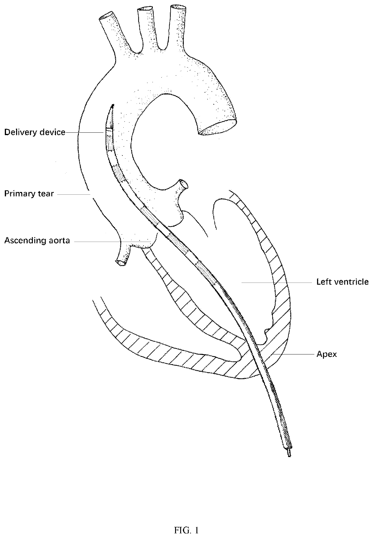 A transapical anatomical stent to repair ascending aorta and hemi arch