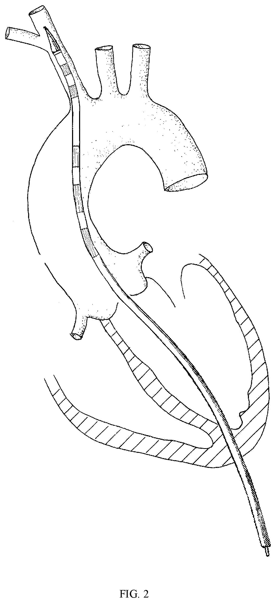 A transapical anatomical stent to repair ascending aorta and hemi arch