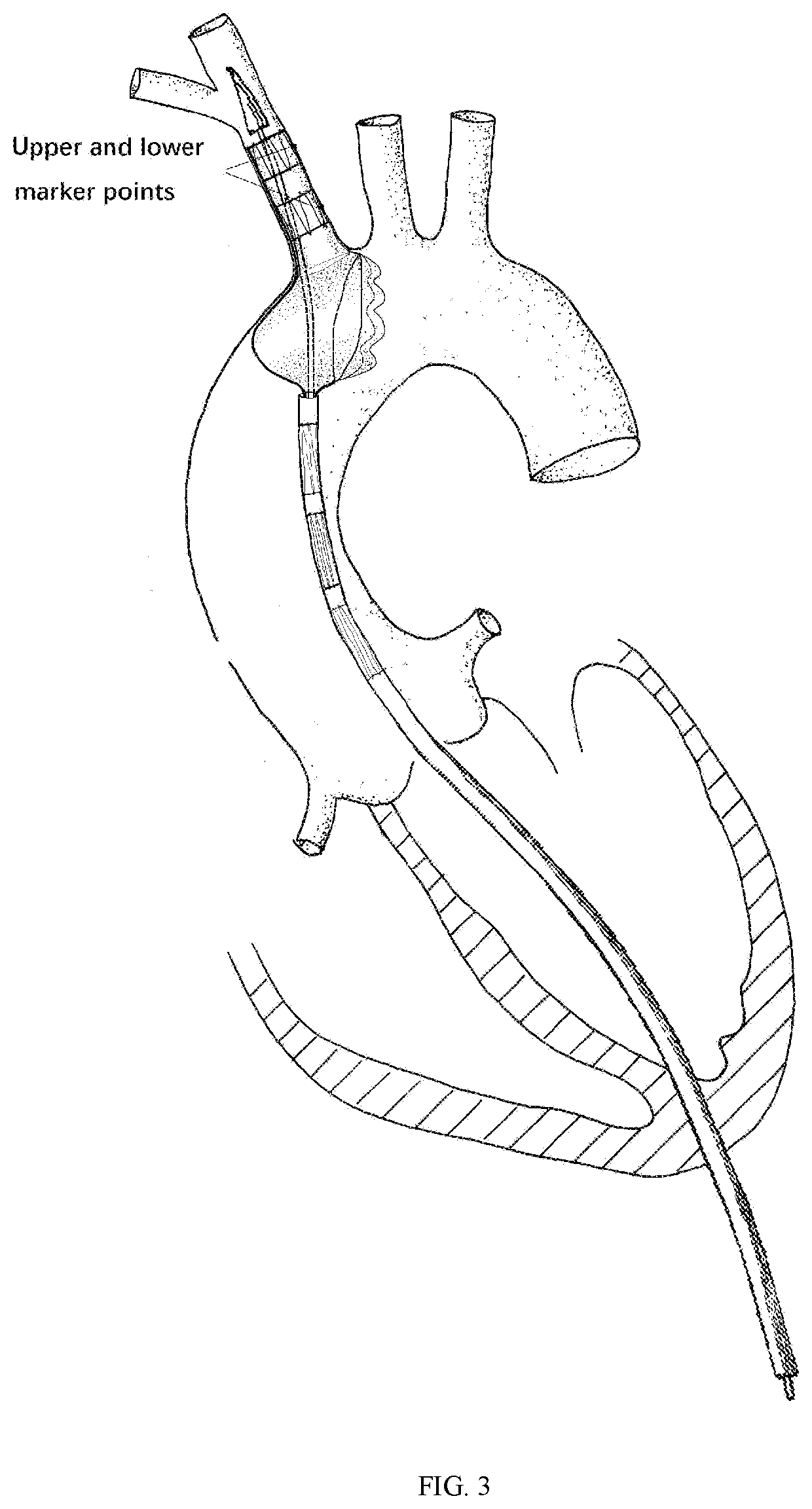 A transapical anatomical stent to repair ascending aorta and hemi arch