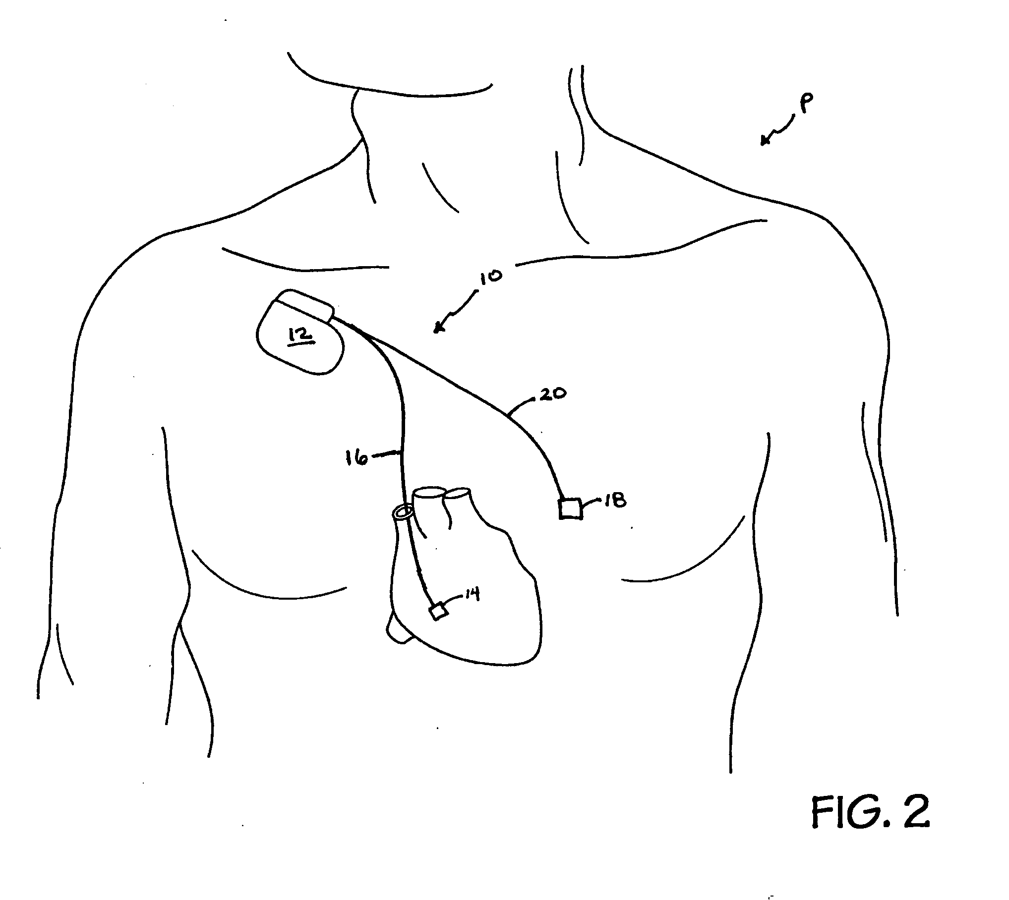 System and method for regulating blood pressure and electrolyte balance