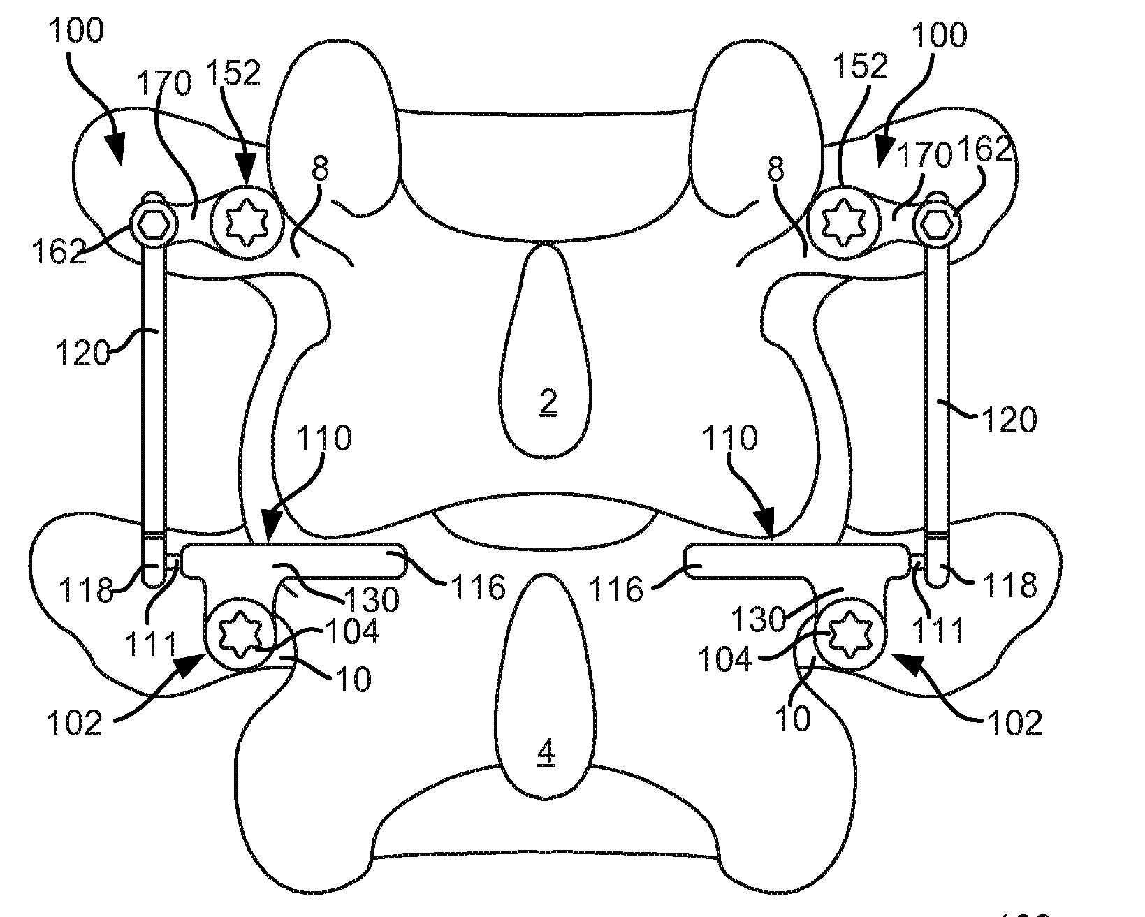 Modular in-line deflection rod and bone anchor system and method for dynamic stabilization of the spine