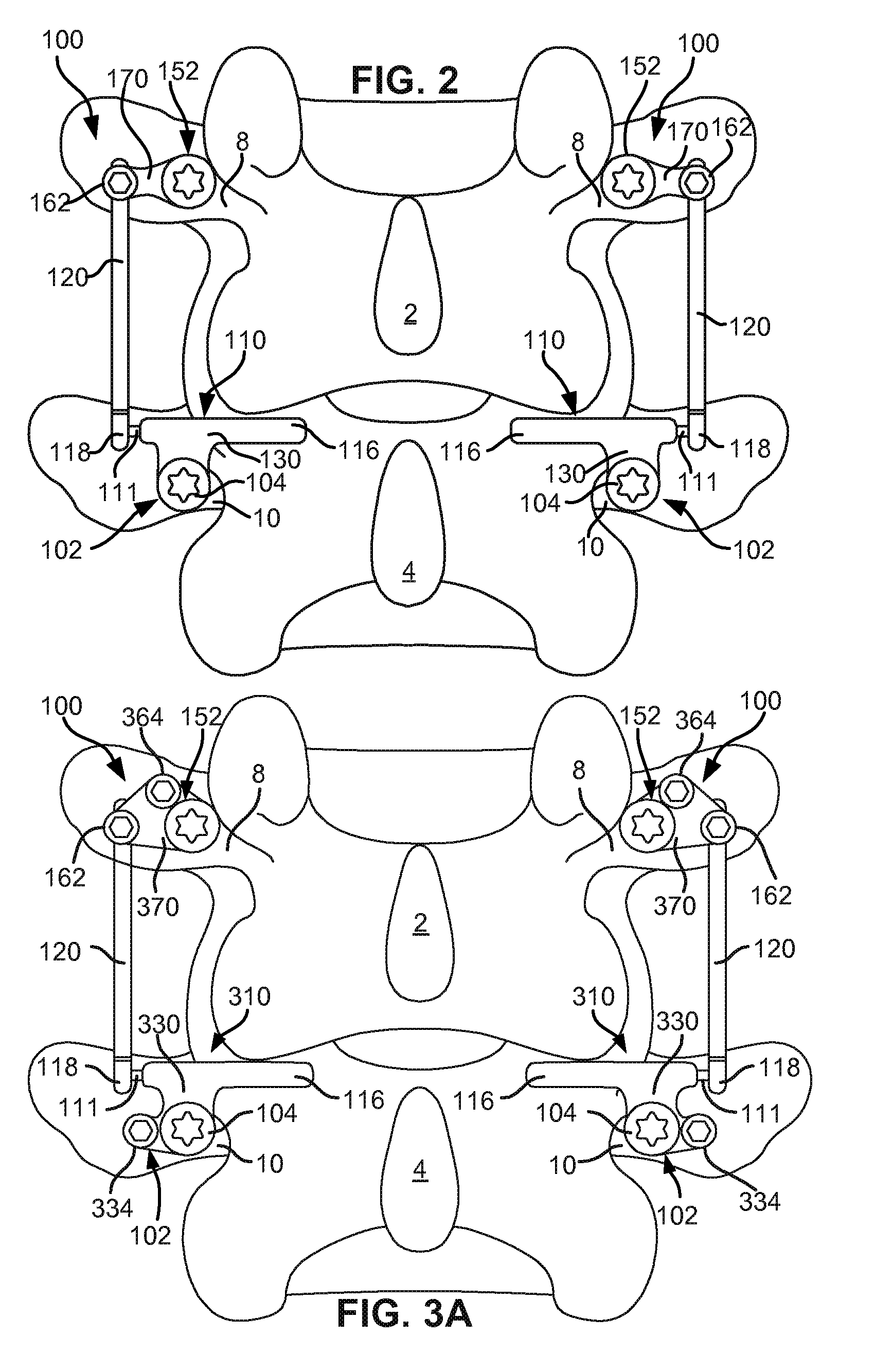 Modular in-line deflection rod and bone anchor system and method for dynamic stabilization of the spine