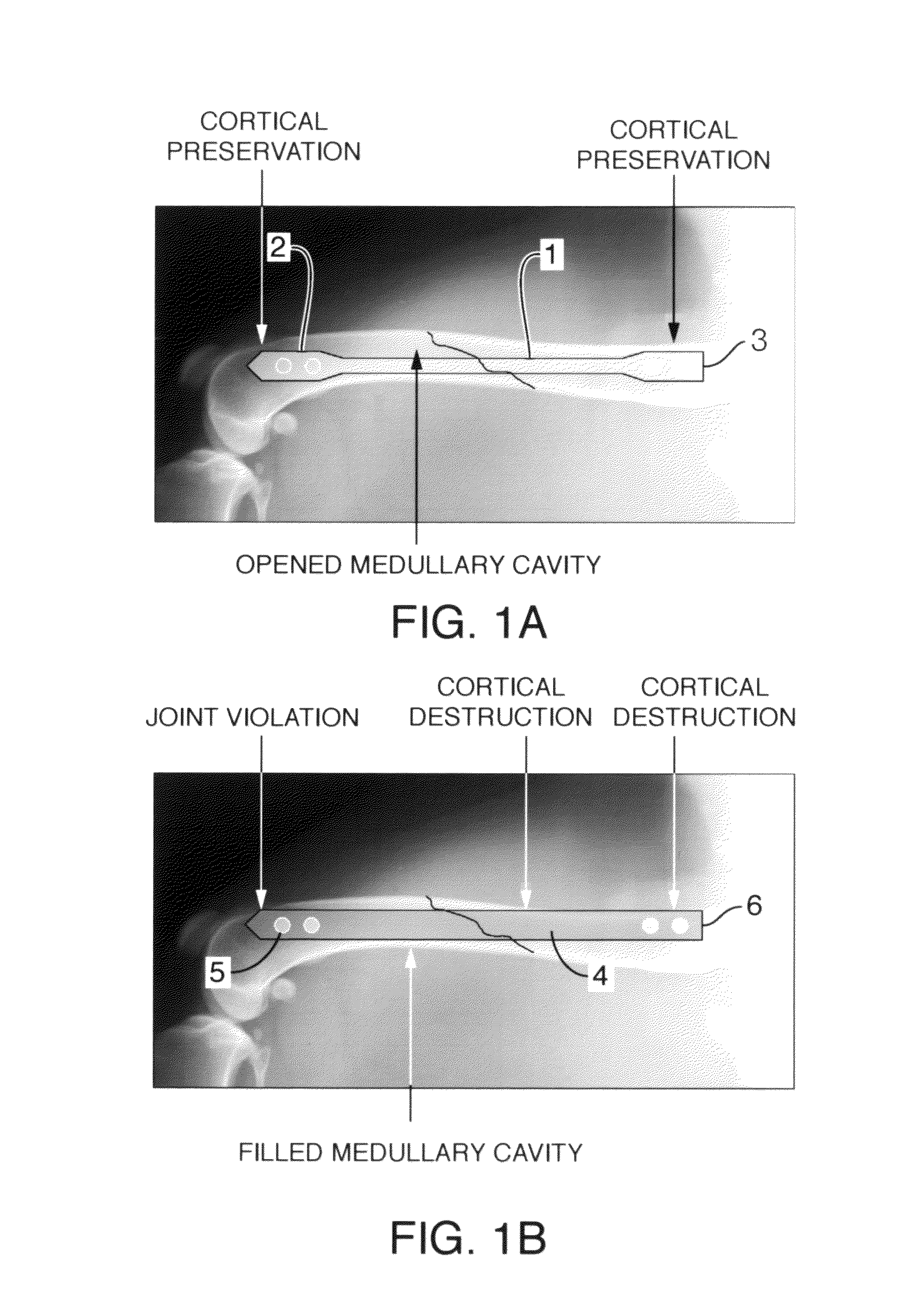 Devices and methods for interlocking surgical screws and nails