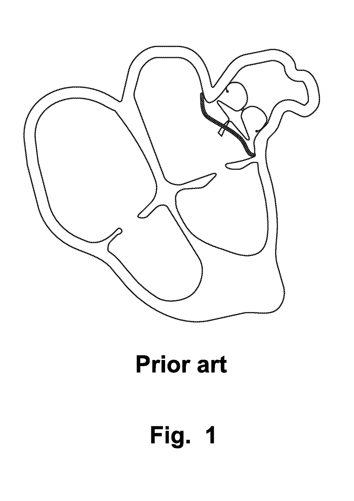 Left Atrial Appendage Occluder