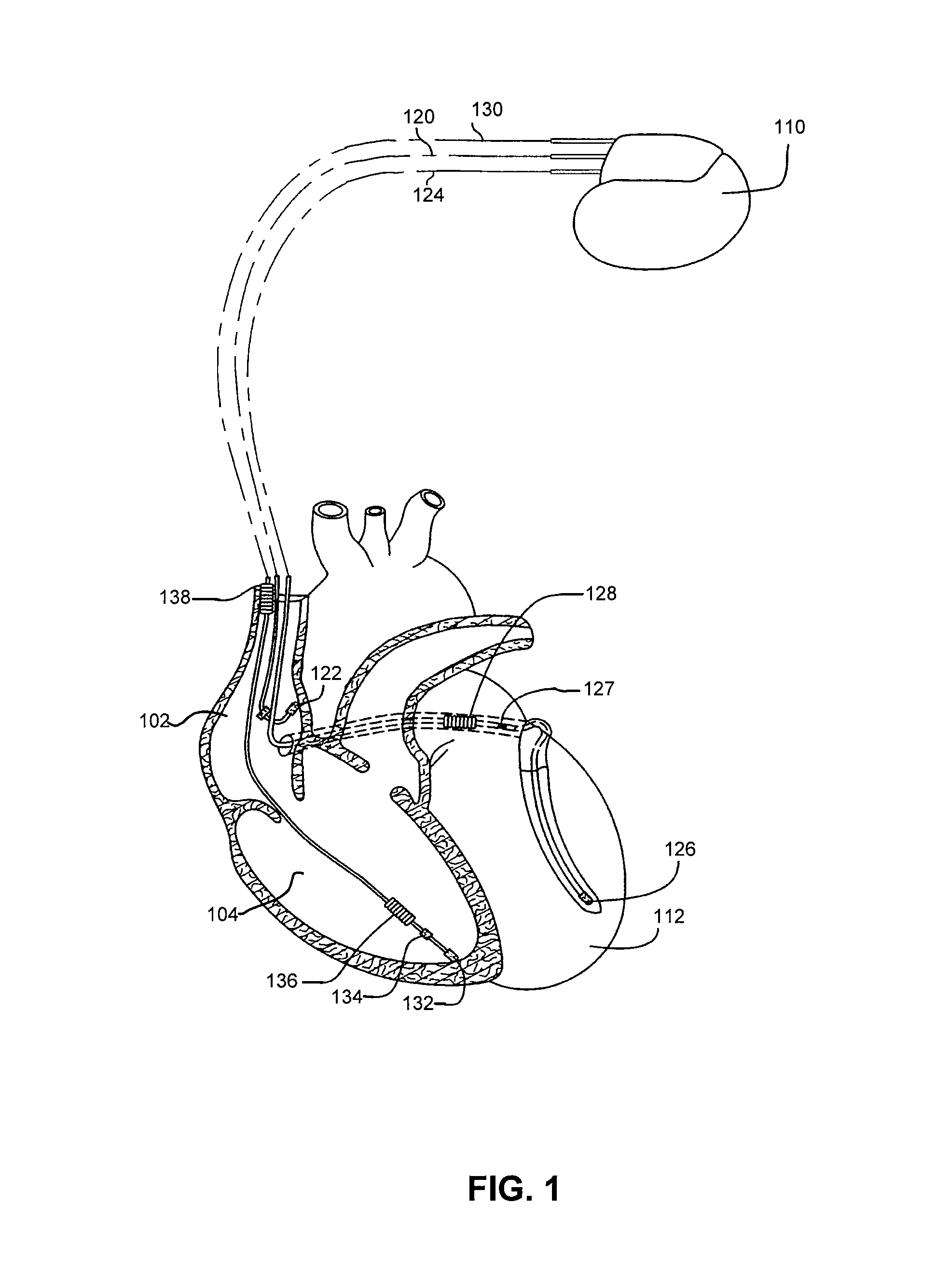 Method and apparatus for monitoring arrythmogenic effects of medications using an implantable device