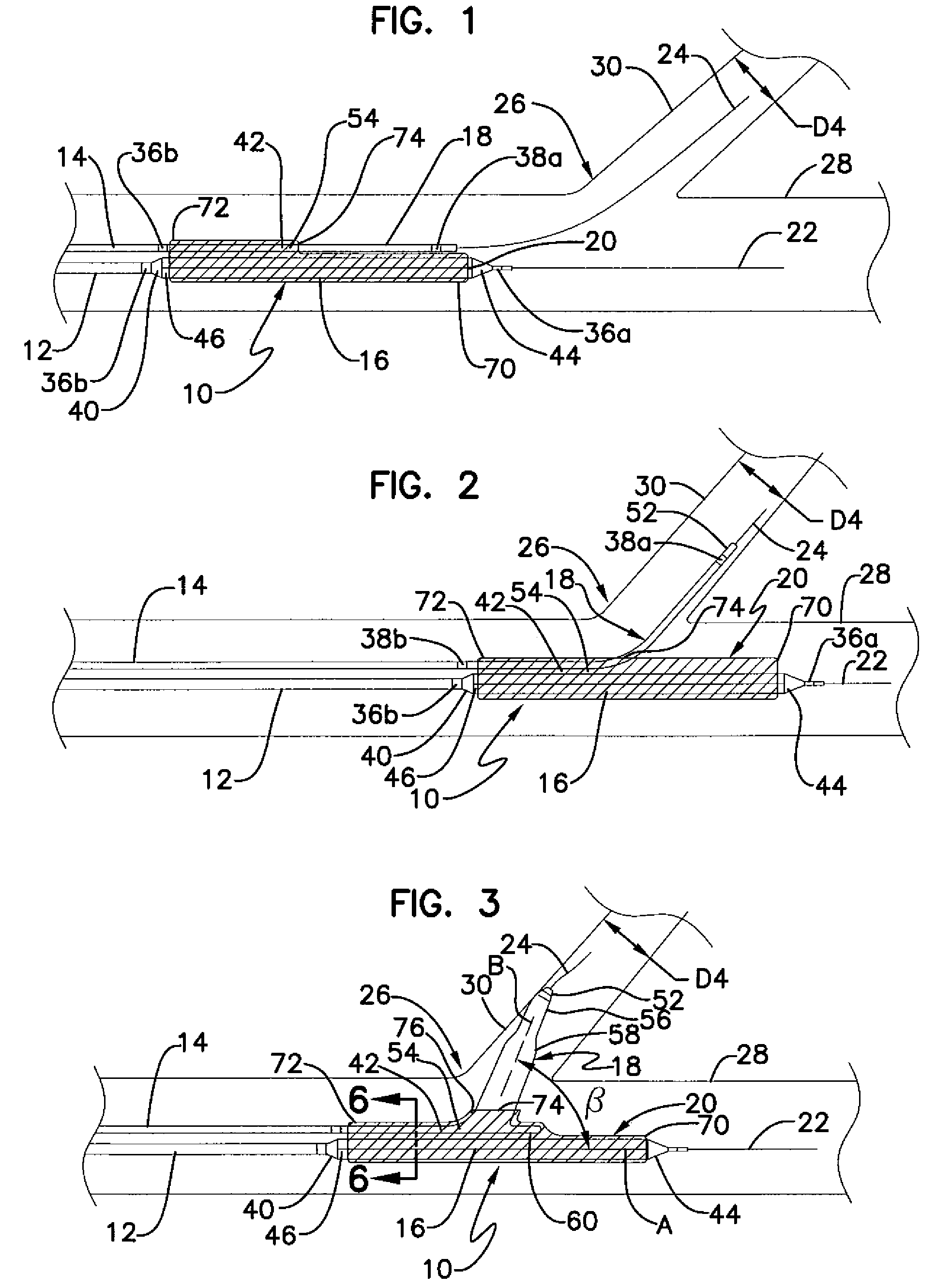 Bifurcation stent delivery system and methods