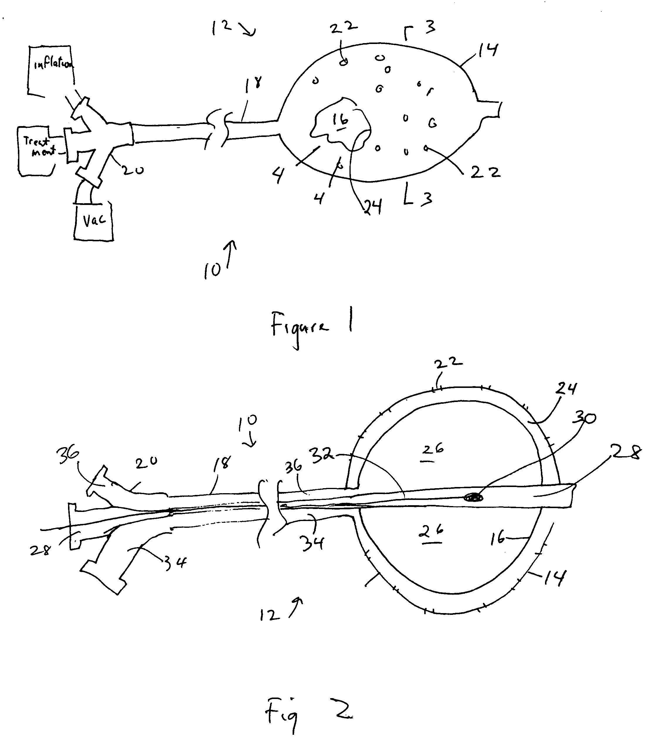 Vacuum device and method for treating tissue adjacent a body cavity