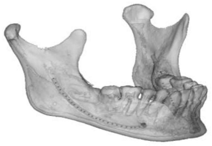 3D printing mandible impacted wisdom tooth extraction training model