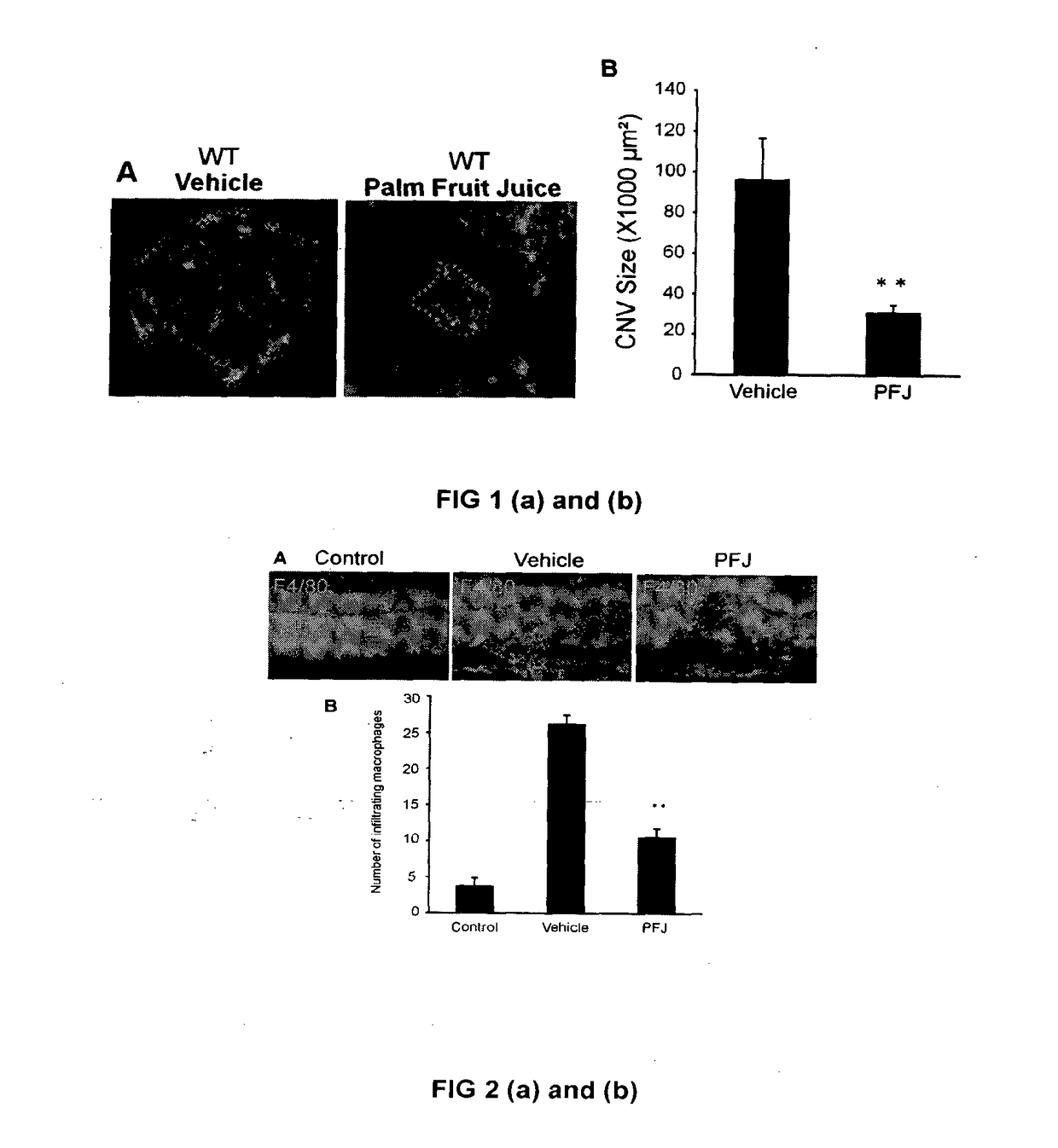 Compositions comprising extracts or materials derived from palm oil vegetation liquor for inhibition of vision loss due to angiogenesis and method of preparation there