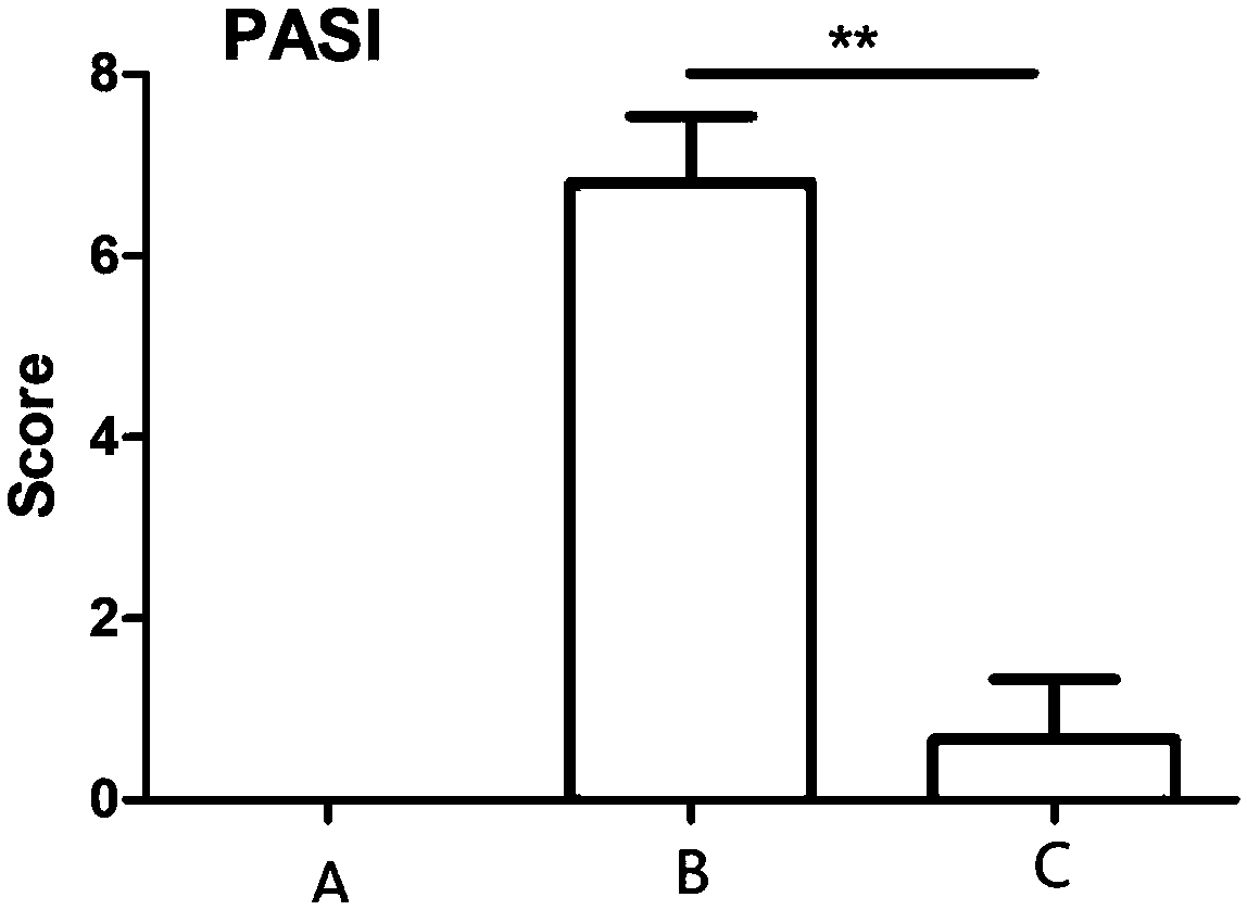 Application of gemcitabine in preparing drug for treating psoriasis, drug and preparation method thereof