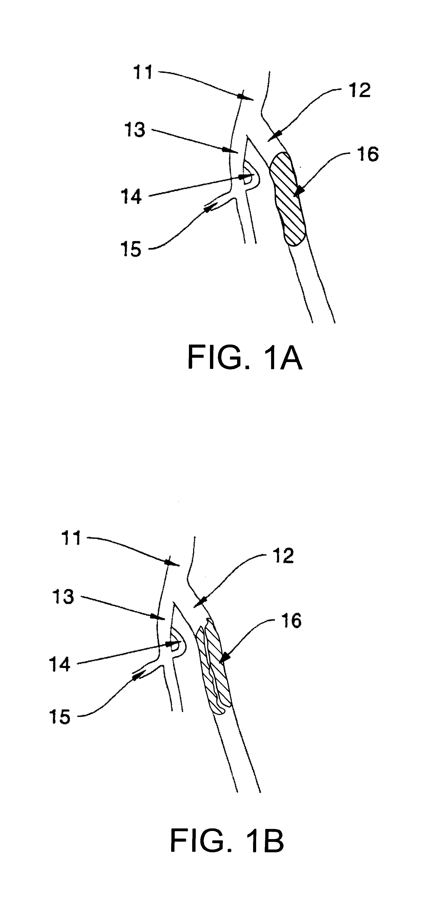 Catheter devices and methods for their use in the treatment of calcified vascular occlusions
