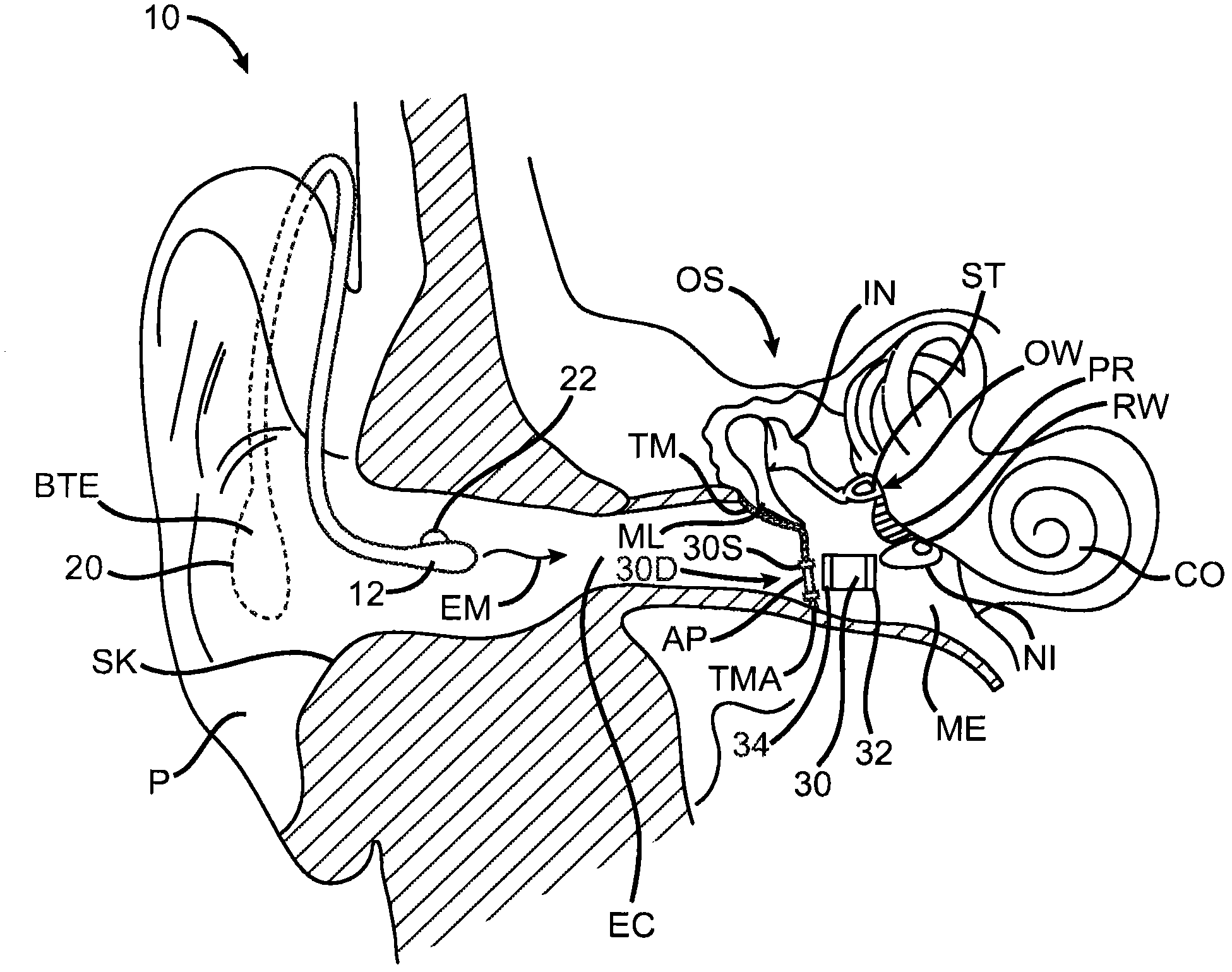 Eardrum implantable devices for hearing systems and methods - Eureka ...