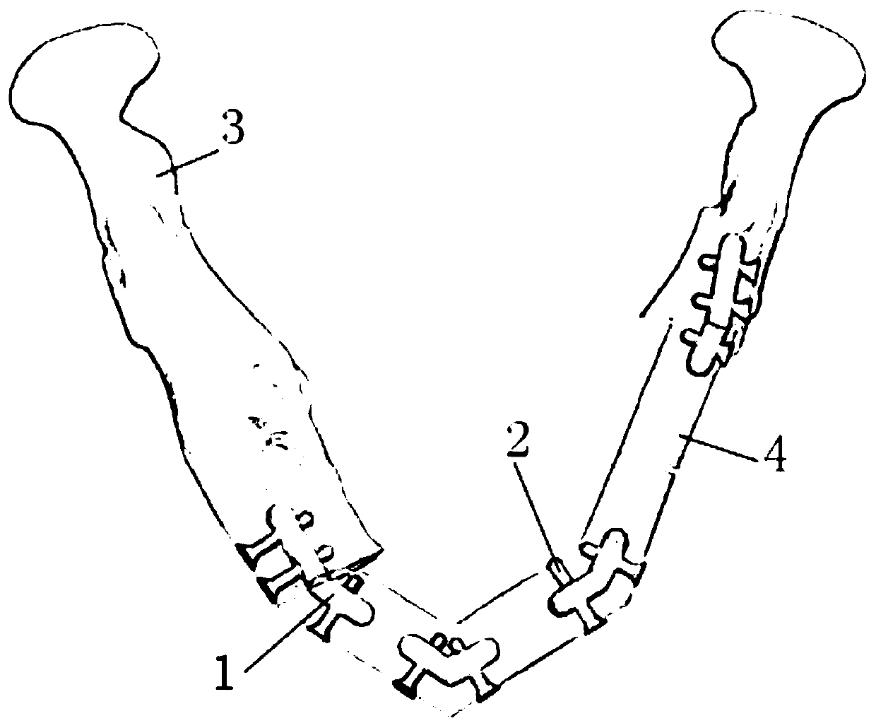 Internal fixation fibula reconstruction mandible method