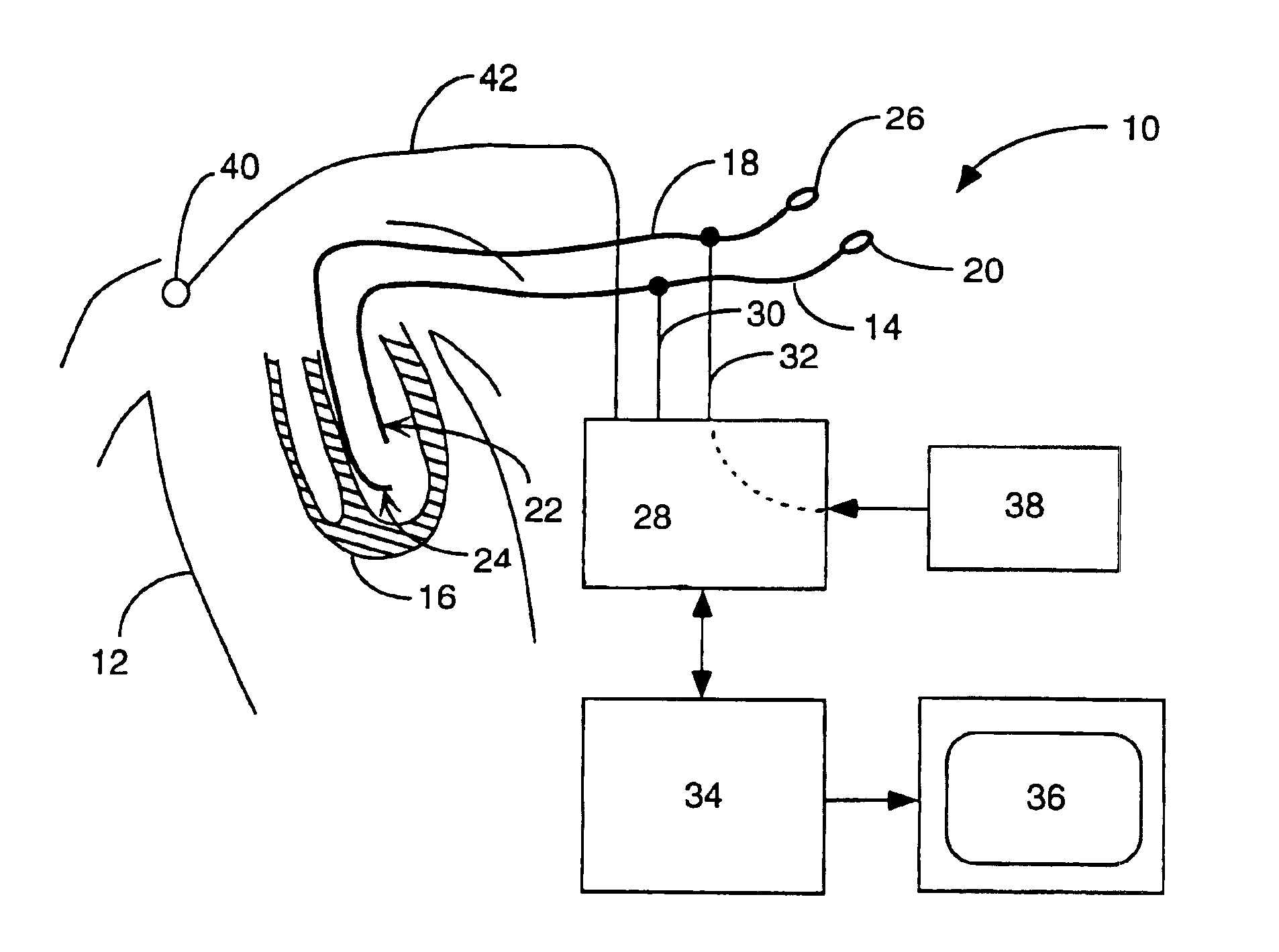 Interface system for endocardial mapping catheter