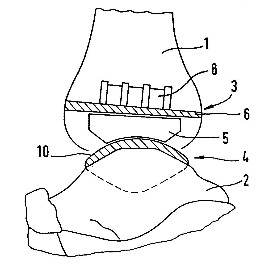 Ankle-joint endoprosthesis