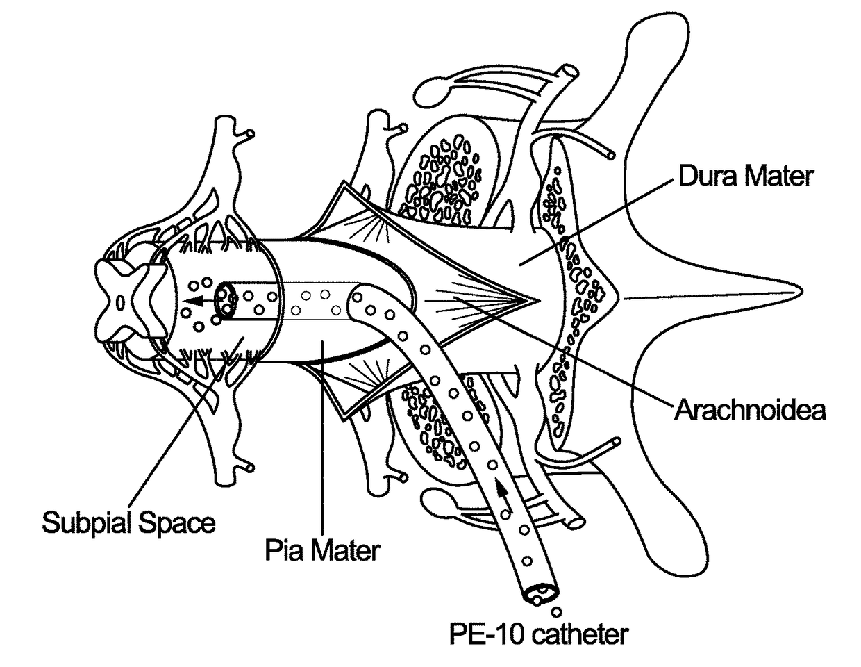 Spinal subpial gene delivery system