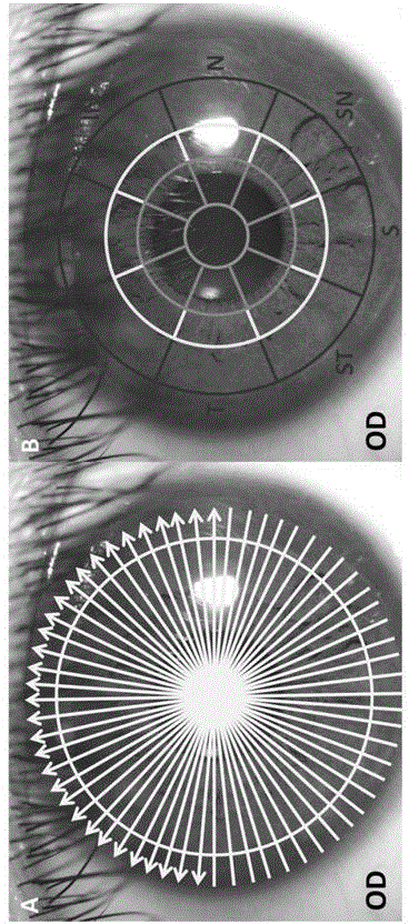 Keratectasia measurement method based on optical CT