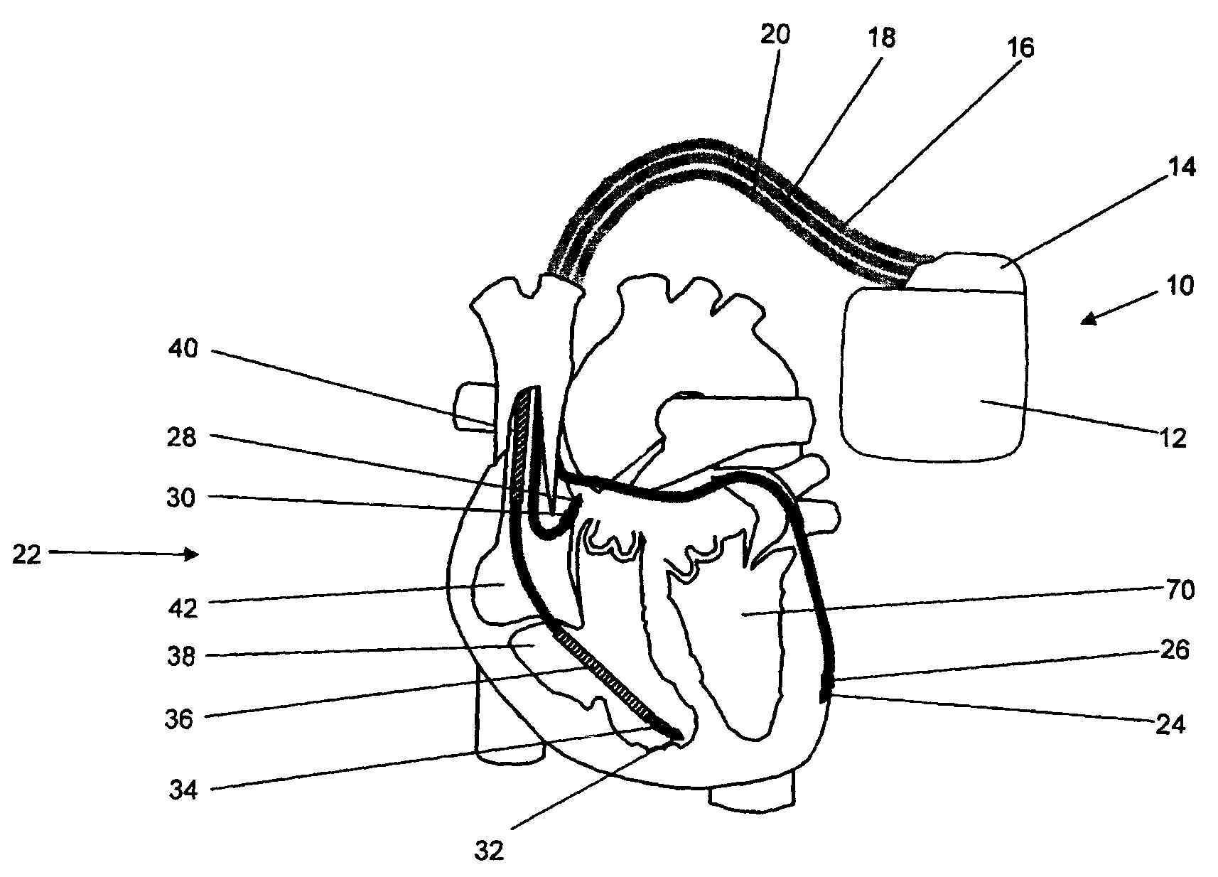 Implantable medical device and method for LV coronary sinus lead implant site optimization