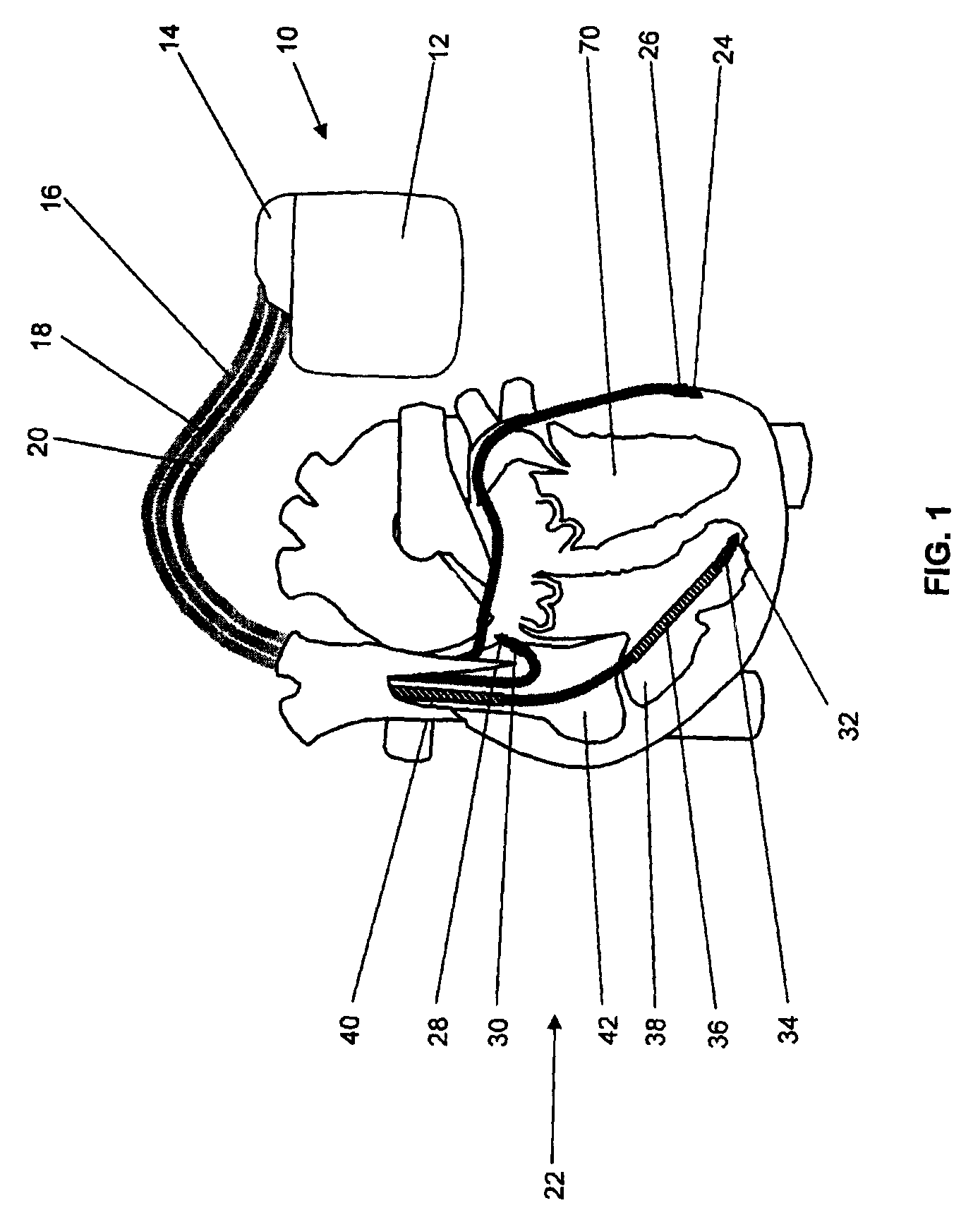 Implantable medical device and method for LV coronary sinus lead implant site optimization