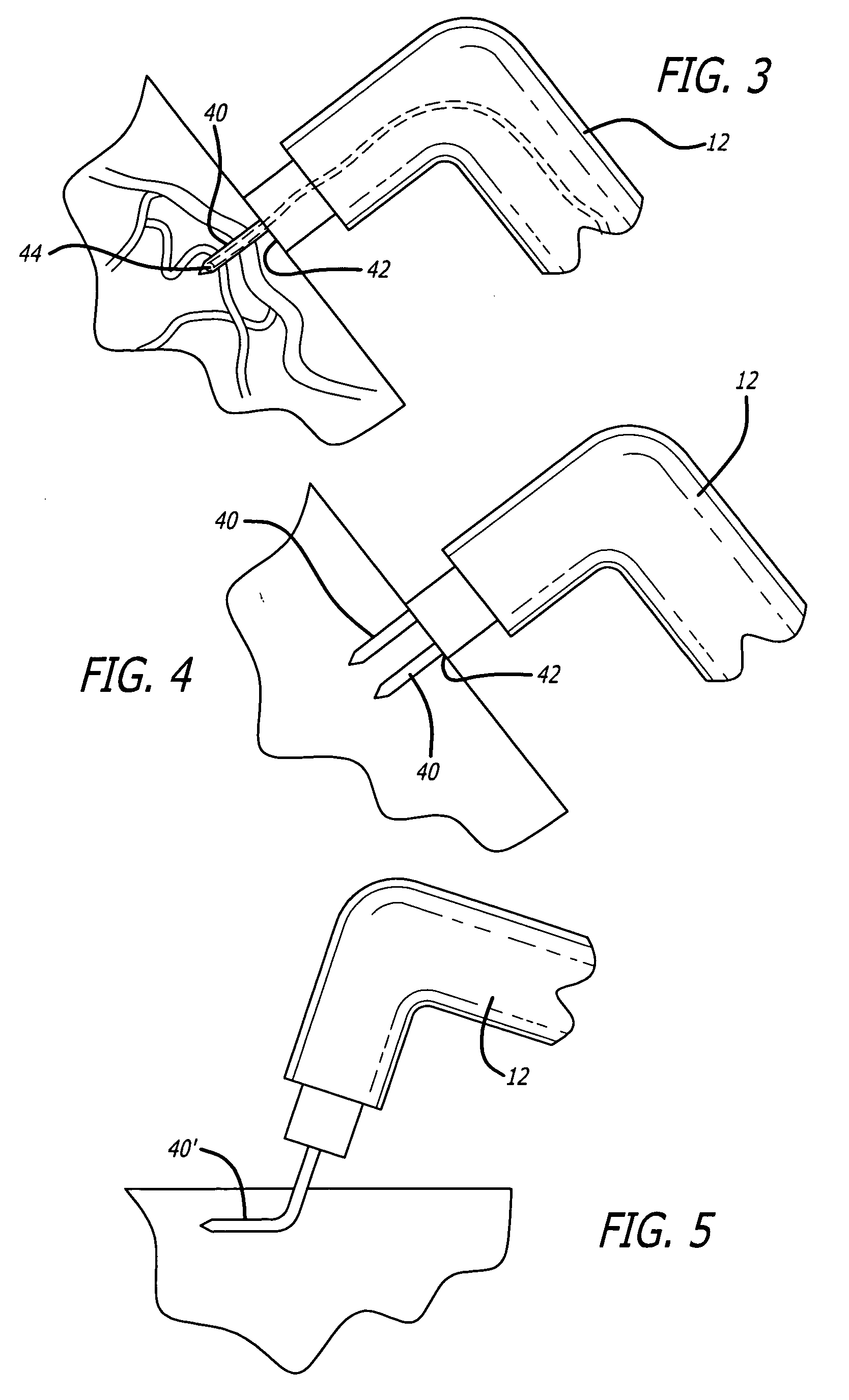 Method and apparatus for shrinking tissue