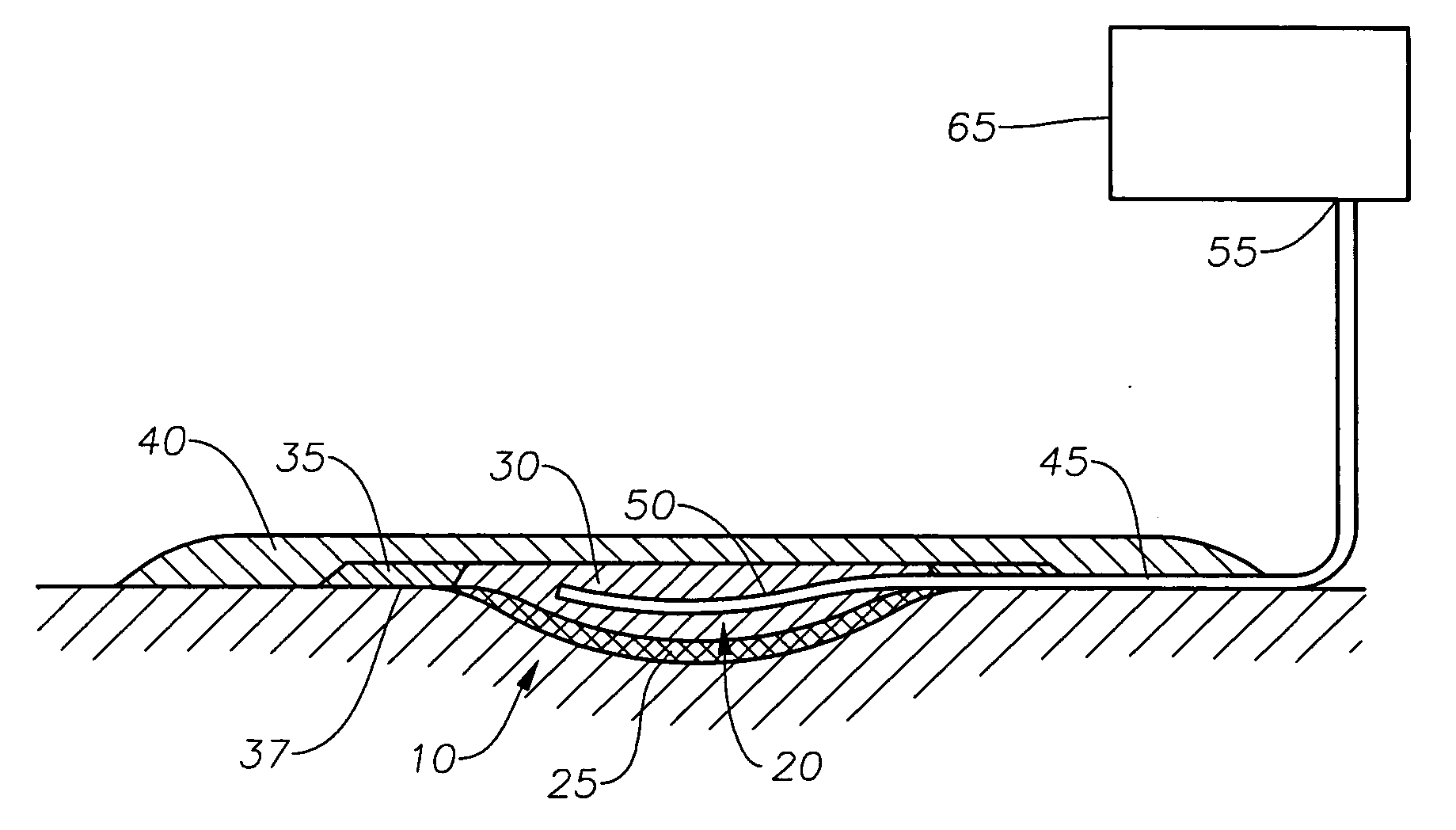 Method and apparatus for treating a wound