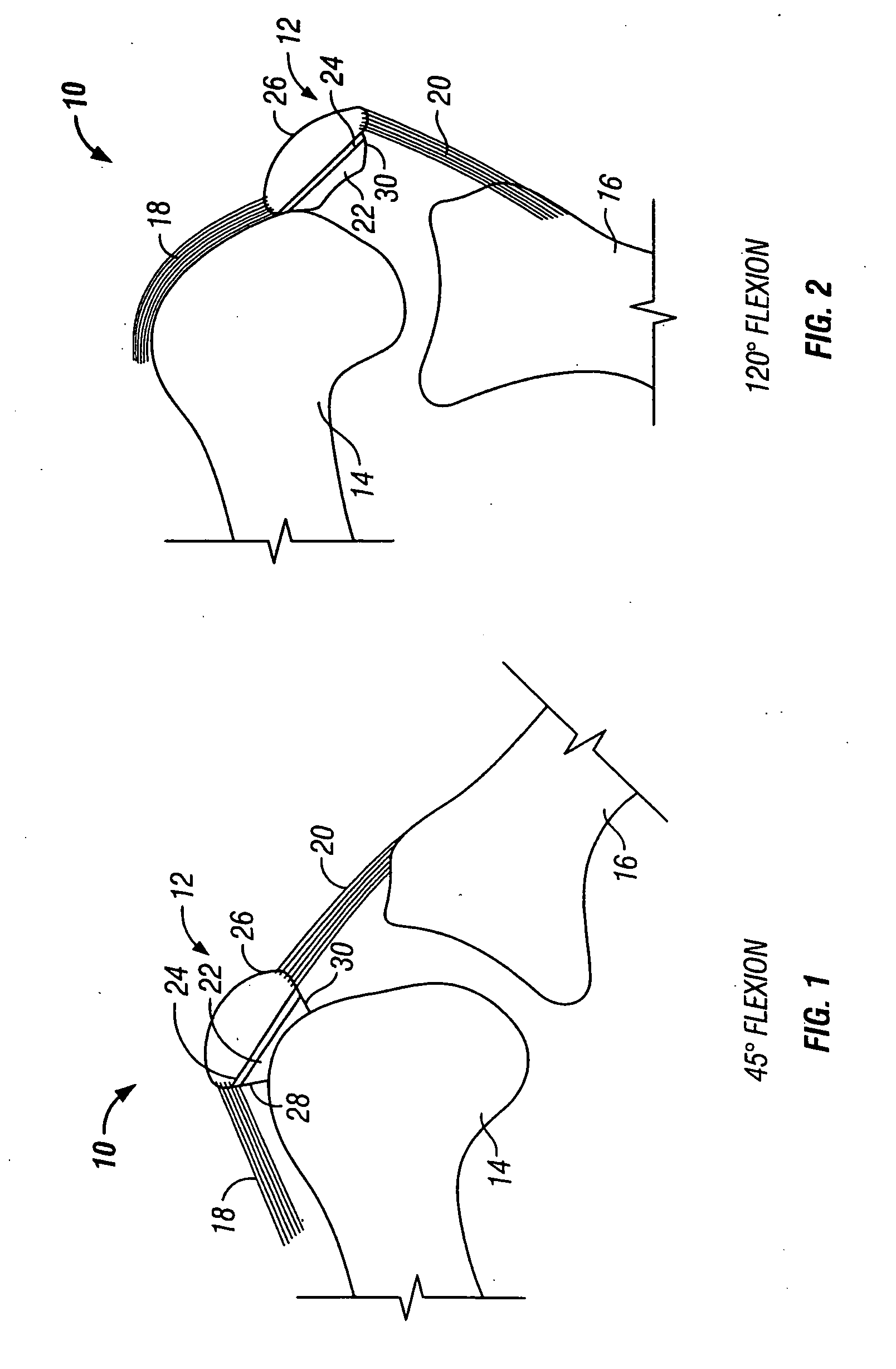 Patellar prosthetic arrangement and associated surgical method