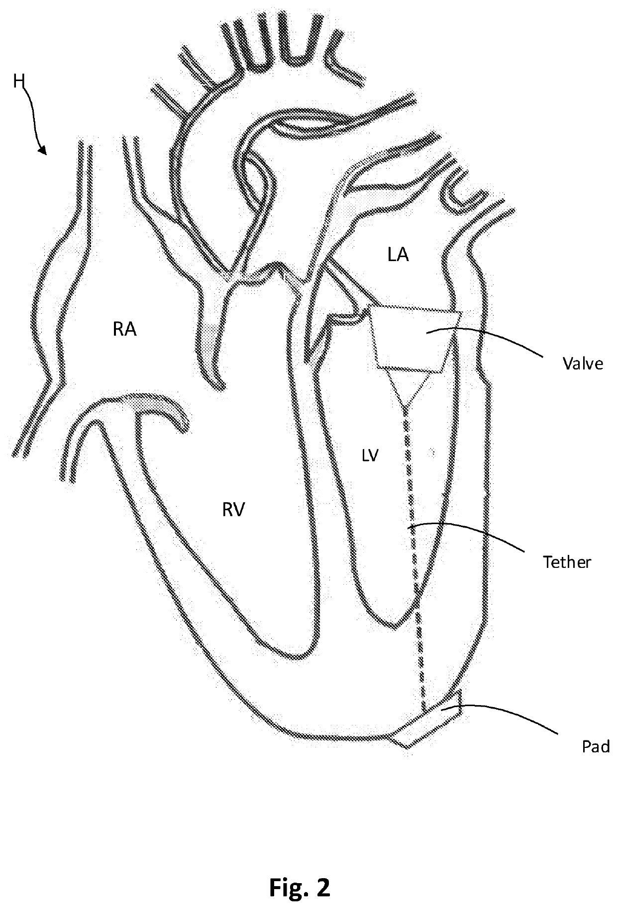 Apparatus And Methods For Delivery Of A Prosthetic Valve Within An Existing Implanted Prosthetic Valve