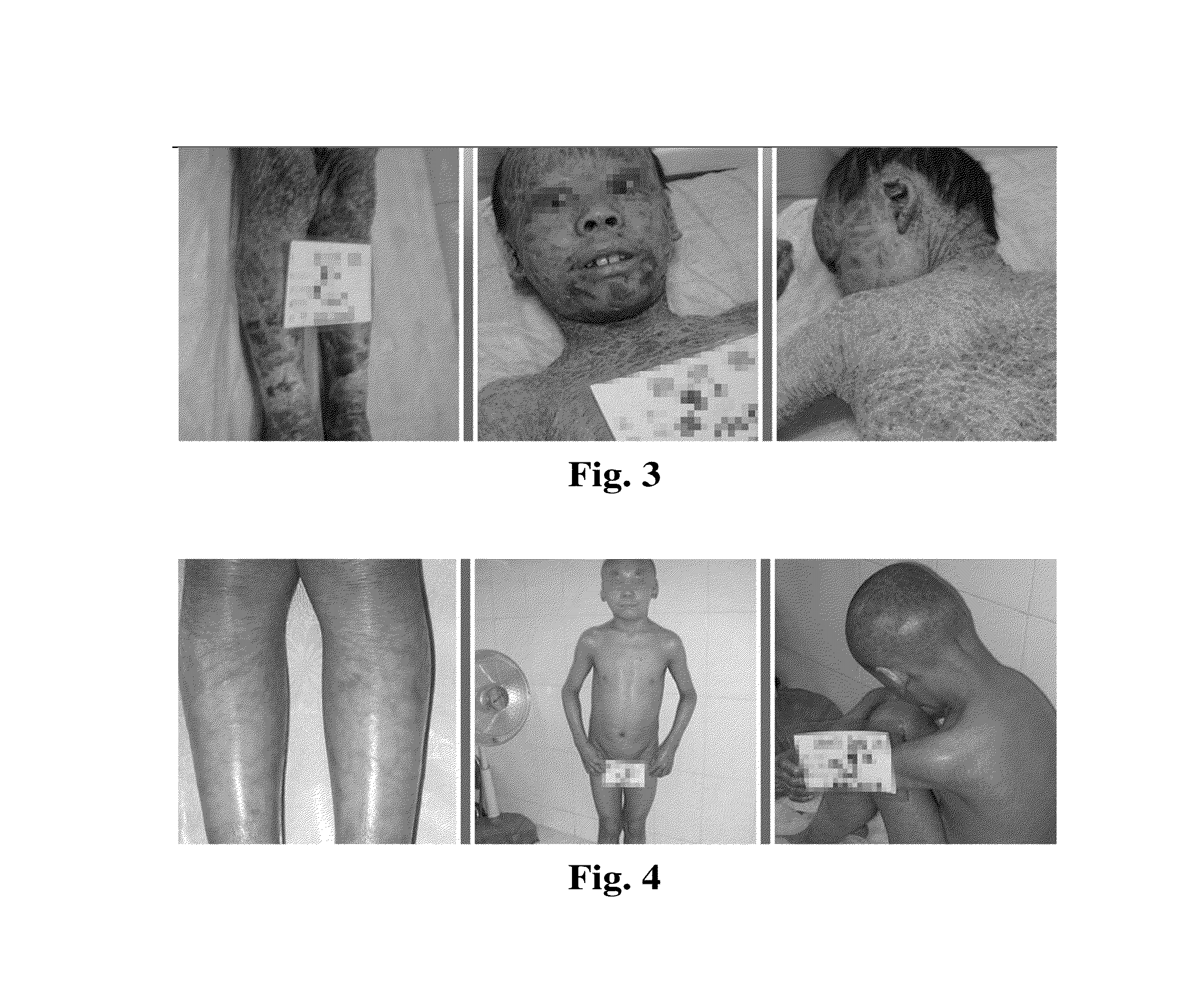 External-use traditional chinese medicine for ichthyosis and xerodermia, and preparation method thereof