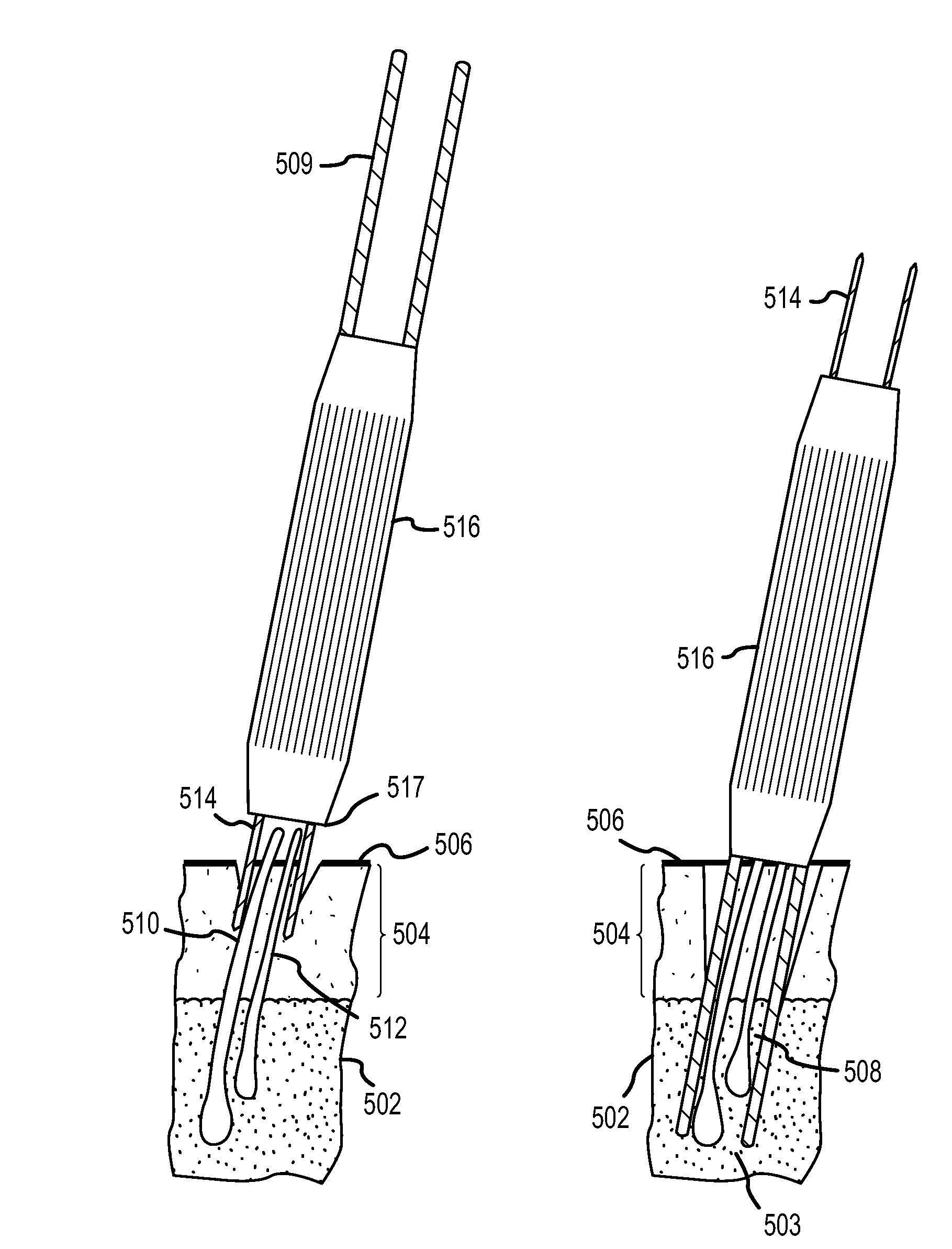 Follicular extraction method and device