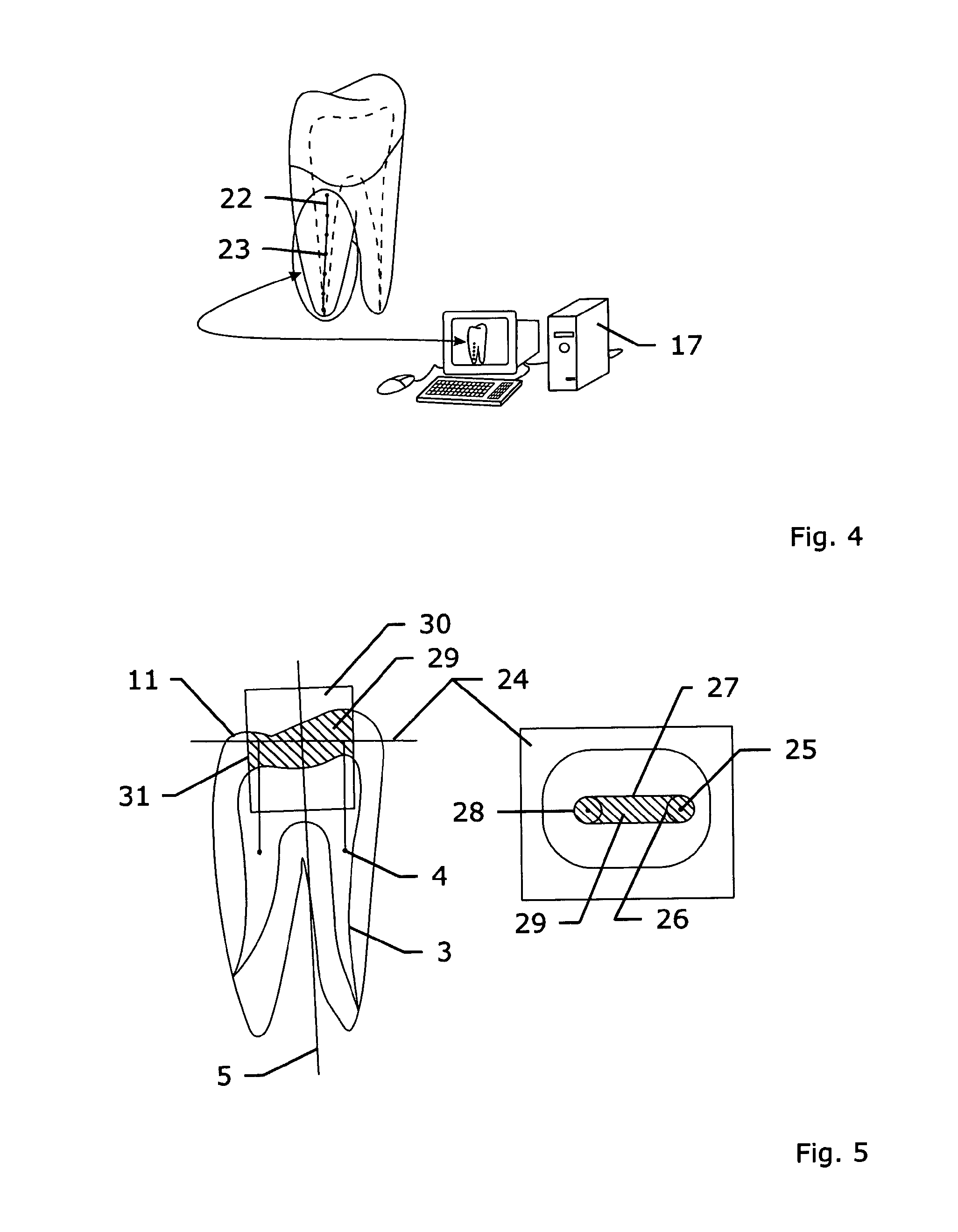 Method and system for establishing the shape of the occlusal access cavity in endodontic treatment