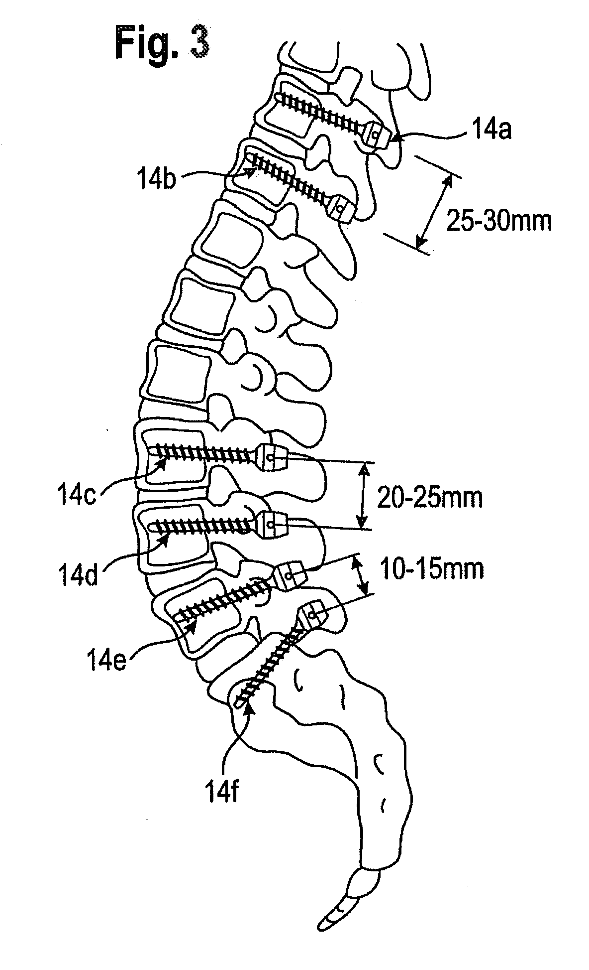 Rod connection in a surgical device and rod-shaped bone stabilization device comprising the same