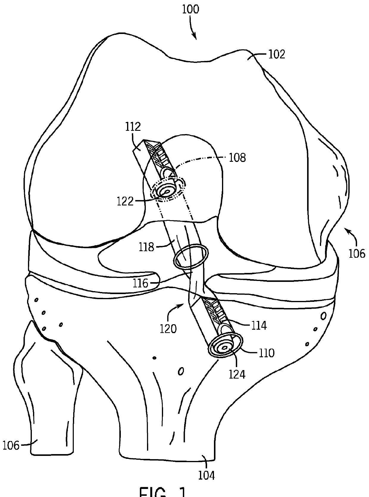 System and Method for Ligament Reconstruction