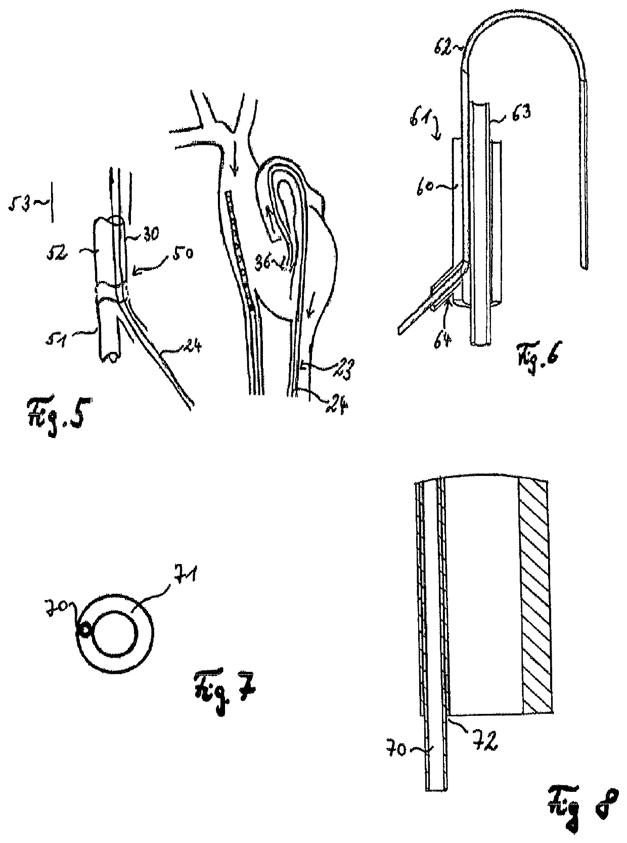 Assembly comprising a suction line, a pressure line and a pump