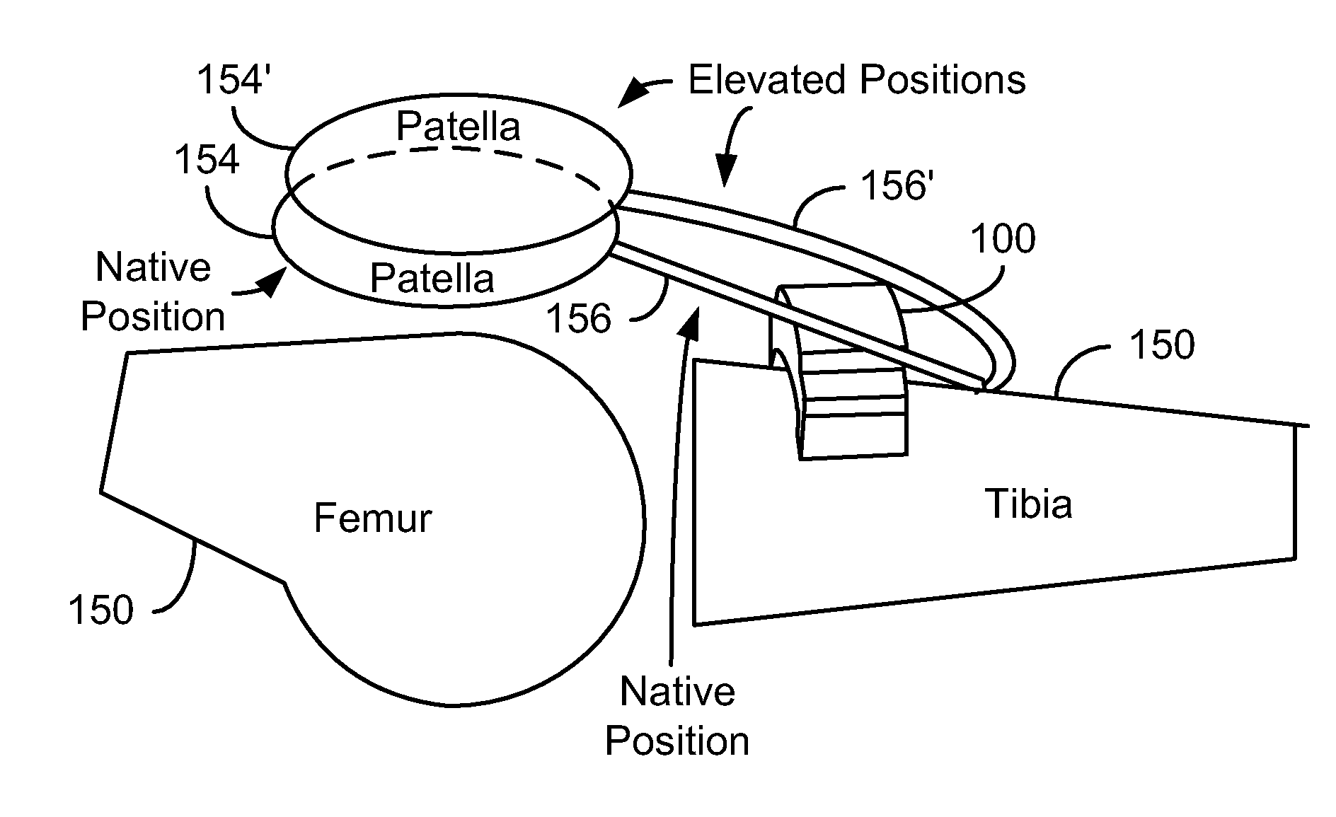 Method and system for patella tendon realignment