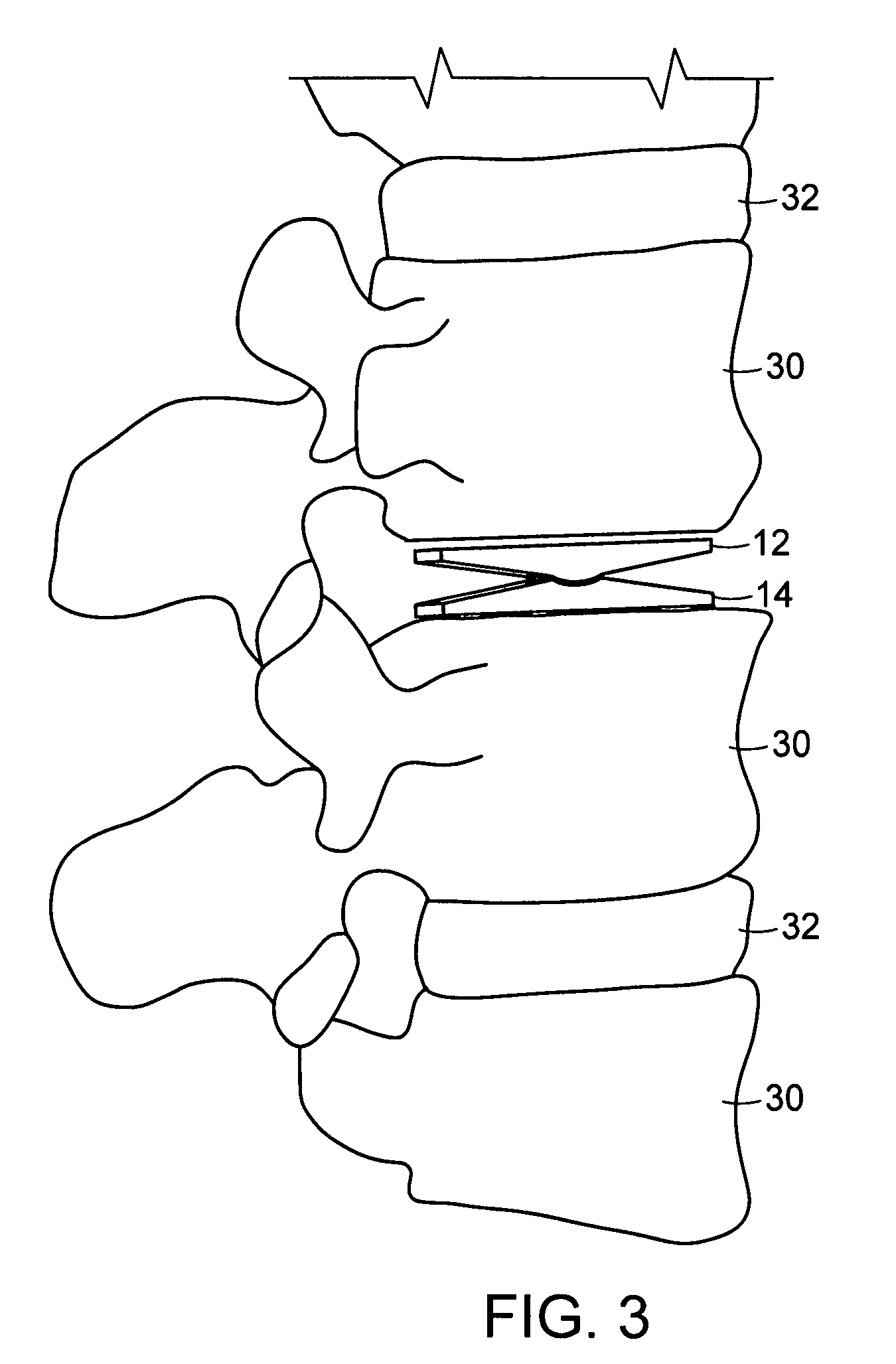 Minimally invasive spinal disc stabilizer and insertion tool