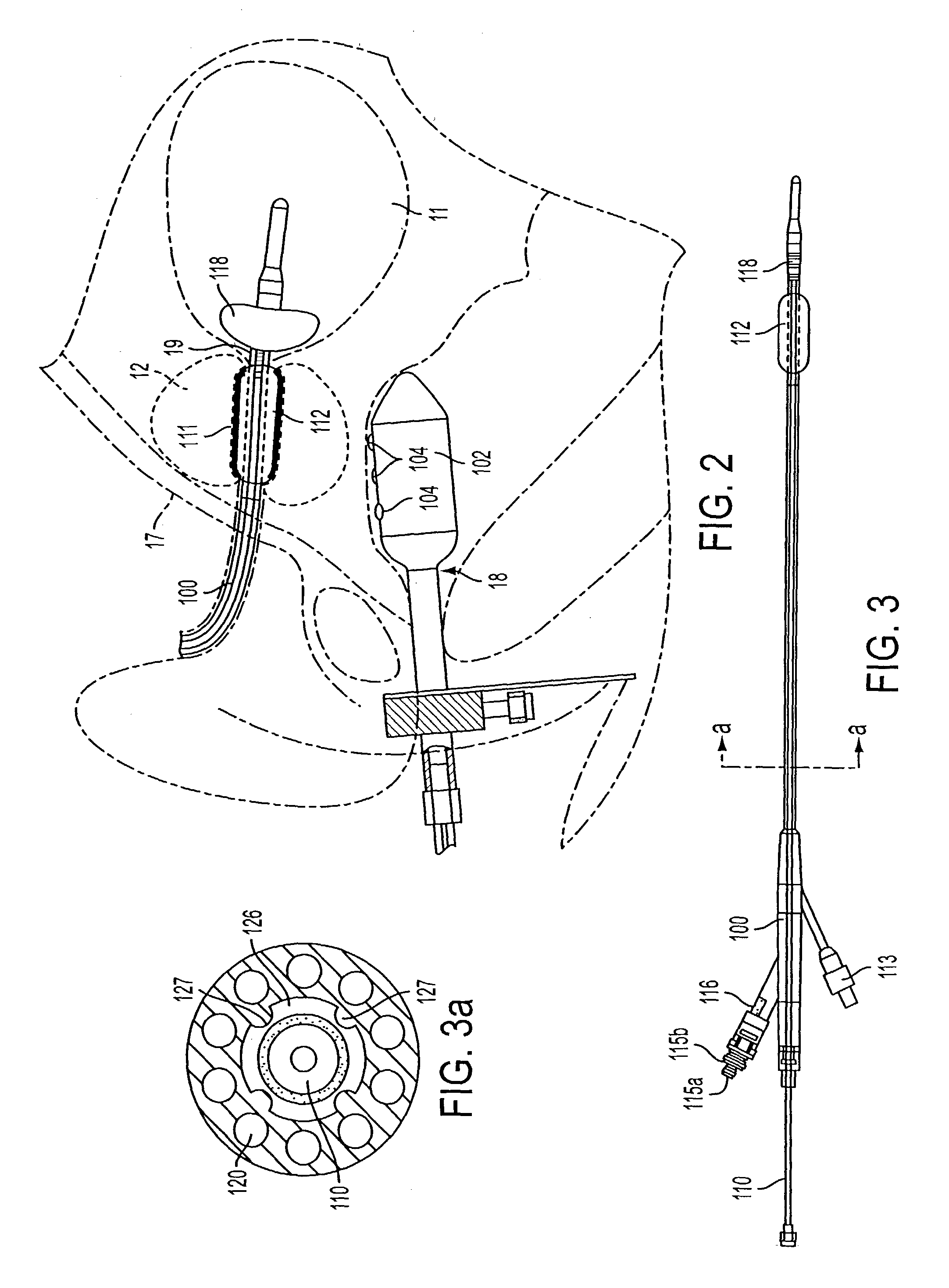 Apparatus for treatment of tissue adjacent a bodily conduit with a gene or drug-coated compression balloon