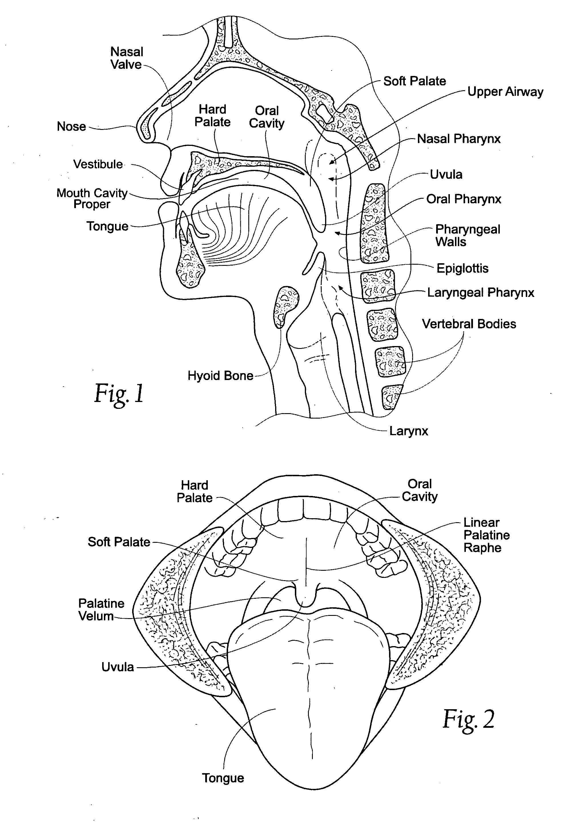 Devices, systems and methods using magnetic force systems in the tongue